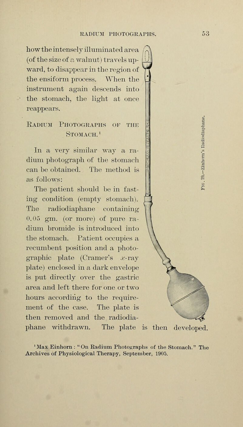 how the intensely illuminated area (of the size of a walnut) travels up- ward, to disappear in the region of the ensiform process. When the instrument again descends into the stomach, the light at once reappears. Radium Photographs Stomach. 1 OF THE In a very similar way a ra- dium photograph of the stomach can be obtained. The method is as follows: The patient should be in fast- ing condition (empty stomach). The radiodiaphane containing 0.05 gm. (or more) of pure ra- dium bromide is introduced into the stomach. Patient occupies a recumbent position and a photo- graphic plate (Cramer's x-raj plate) enclosed in a dark envelope is put directly over the gastric area and left there for one or two hours according to the require- ment of the case. The plate is then removed and the radiodia- phane withdrawn. The plate is then developed. 'Max Einhorn : On Radium Photographs of the Stomach. The Archives of Physiological Therapy, September, 1905.