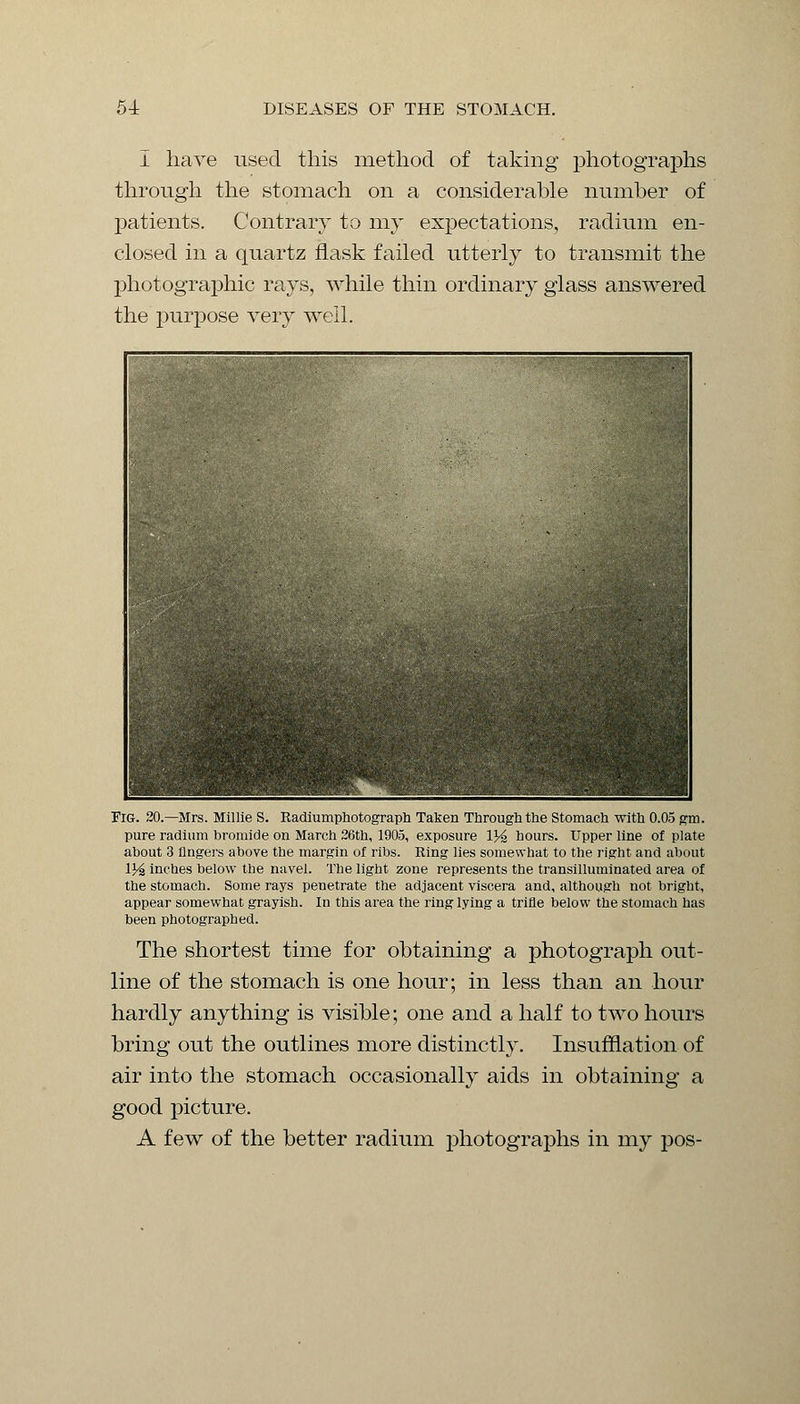 I have used this method of taking photographs through the stomach on a considerable number of patients. Contrary to my expectations, radium en- closed in a quartz flask failed utterly to transmit the photographic rays, while thin ordinary glass answered the purpose very well. Fig. 20.—Mrs. Millie S. Radiumphotograph Taken Through the Stomach with 0.05 gm. pure radium bromide on March 26th, 1905, exposure \y% hours. Upper line of plate about 3 Angers above the margin of ribs. Ring lies somewhat to the right and about V& inches below the navel. The light zone represents the transilluminated area of the stomach. Some rays penetrate the adjacent viscera and, although not bright, appear somewhat grayish. In this area the ring lying a trifle below the stomach has been photographed. The shortest time for obtaining a photograph out- line of the stomach is one hour; in less than an hour hardly anything is visible; one and a half to two hours bring out the outlines more distinctly. Insufflation of air into the stomach occasionally aids in obtaining a good picture. A few of the better radium photographs in my pos-
