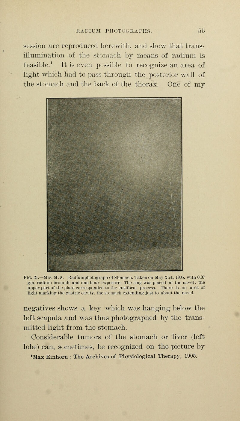 session are reproduced herewith, and show that trans- illumination of the stomach by means of radium is feasible.1 It is even possible to recognize an area of light which had to pass through the posterior wall of the stomach and the back of the thorax. One of my Fig. 21.—Mrs. M. S. Radiumphotograph of Stomach, Taken on May 21st, 1905, with 0.07 gm. radium bromide and one hour exposure. The ring was placed on the navel; the upper part of the plate corresponded to the ensiform process. There is an area of light marking the gastric cavity, the stomach extending just to about the navel. negatives shows a key which was hanging below the left scapula and was thus photographed by the trans- mitted light from the stomach. Considerable tumors of the stomach or liver (left lobe) can, sometimes, be recognized on the picture by 'Max Einhorn : The Archives of Physiological Therapy, 1905.