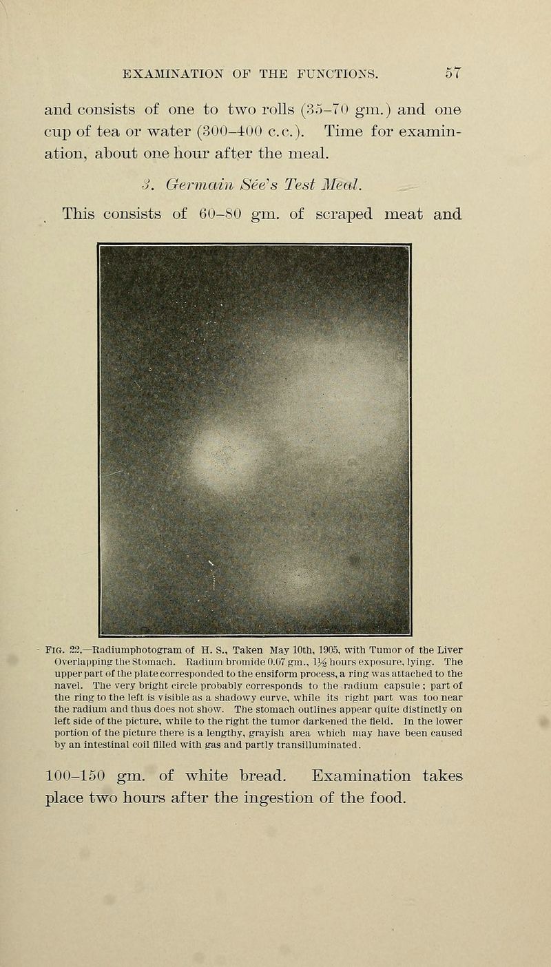 and consists of one to two rolls (35-70 gm.) and one cup of tea or water (300-400 c.c). Time for examin- ation, about one hour after the meal. 3. Germain See's Test Meal. This consists of 60-80 gm. of scraped meat and Fig. 22.—Radiumphotogram of H. S., Taken May 10th, 1905, with Tumor of the Liver Overlapping the Stomach. Radium bromide 0.07 gm., V/z hours exposure, lying. The upper part of the plate corresponded to the ensiform process, a ring was attached to the navel. The very bright circle probably corresponds to the radium capsule ; part of the ring to the left is visible as a shadowy curve, while its right part was too near the radium and thus does not show. The stomach outlines appear quite distinctly on left side of the picture, while to the right the tumor darkened the field. In the lower portion of the picture there is a lengthy, grayish area which may have been caused by an intestinal coil filled with gas and partly transilluminated. 100-150 gm. of white bread. Examination takes place two hours after the ingestion of the food.