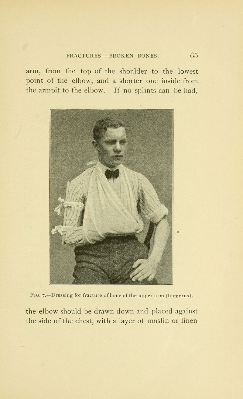 arm, from the top of the shoulder to the lowest point of the elbow, and a shorter one inside from the armpit to the elbow. If no splints can be had, Fig. 7.—Dressing for fracture of bone of Ihe upper arm (humerus). the elbow should be drawn down and placed against the side of the chest, with a layer of muslin or linen