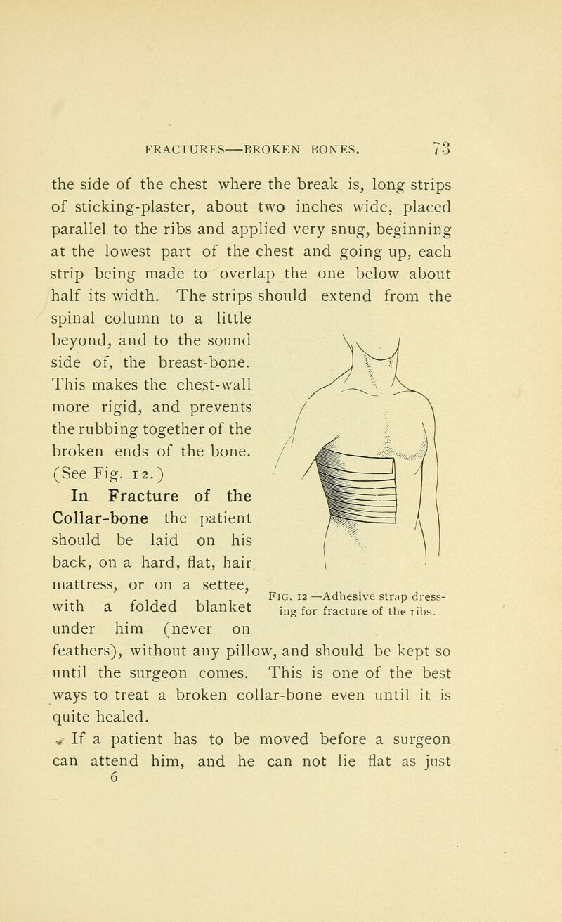 the side of the chest where the break is, long strips of sticking-plaster, about two inches wide, placed parallel to the ribs and applied very snug, beginning at the lowest part of the chest and going up, each strip being made to overlap the one below about half its width. The strips should extend from the spinal column to a little beyond, and to the sound side of, the breast-bone. This makes the chest-wall more rigid, and prevents the rubbing together of the broken ends of the bone. (See Fig. 12.) In Fracture of the Collar-bone the patient should be laid on his back, on a hard, flat, hair. mattress, or on a settee, with a folded blanket under him (never on feathers), without any pillow, and should be kept so until the surgeon comes. This is one of the best ways to treat a broken collar-bone even until it is quite healed. .* If a patient has to be moved before a surgeon can attend him, and he can not lie flat as just 6 Fig. 12 —Adhesive strap dress- ing for fracture of the ribs.