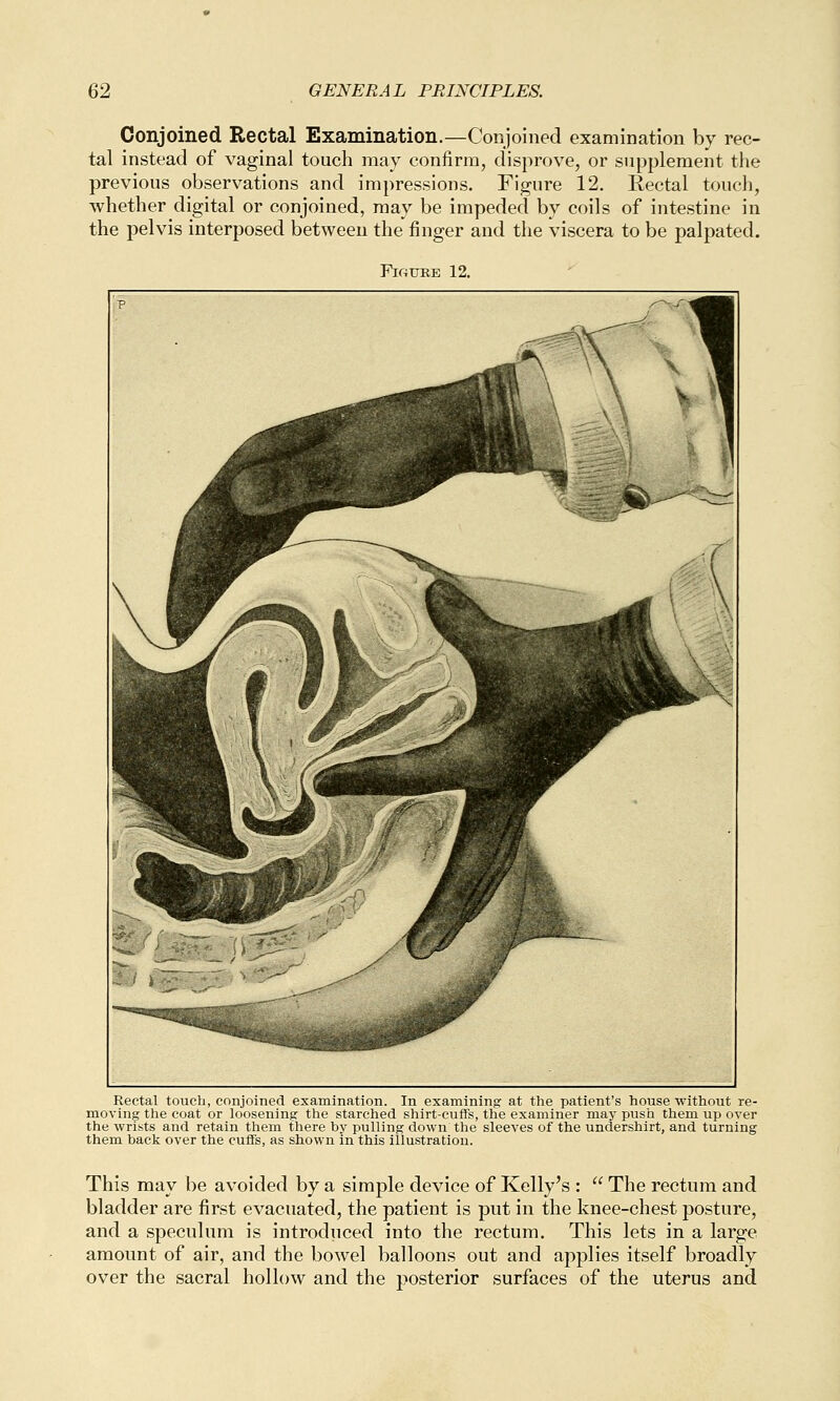 Conjoined Rectal Examination.—Conjoined examination by rec- tal instead of vaginal touch may confirm, disprove, or supplement the previous observations and impressions. Figure 12. Rectal touch, whether digital or conjoined, may be impeded by coils of intestine in the pelvis interposed between the finger and the viscera to be palpated. Figure 12. Rectal touch, conjoined examination. In examining at the patient's house without re- moving the coat or loosening the starched shirt-cuffs, the examiner may push them up over the wrists and retain them there by pulling down the sleeves of the undershirt, and turning them back over the cuffs, as shown in this illustration. This may be avoided by a simple device of Kelly's :  The rectum and bladder are first evacuated, the patient is put in the knee-chest posture, and a speculum is introduced into the rectum. This lets in a large amount of air, and the bowel balloons out and applies itself broadly over the sacral hollow and the posterior surfaces of the uterus and