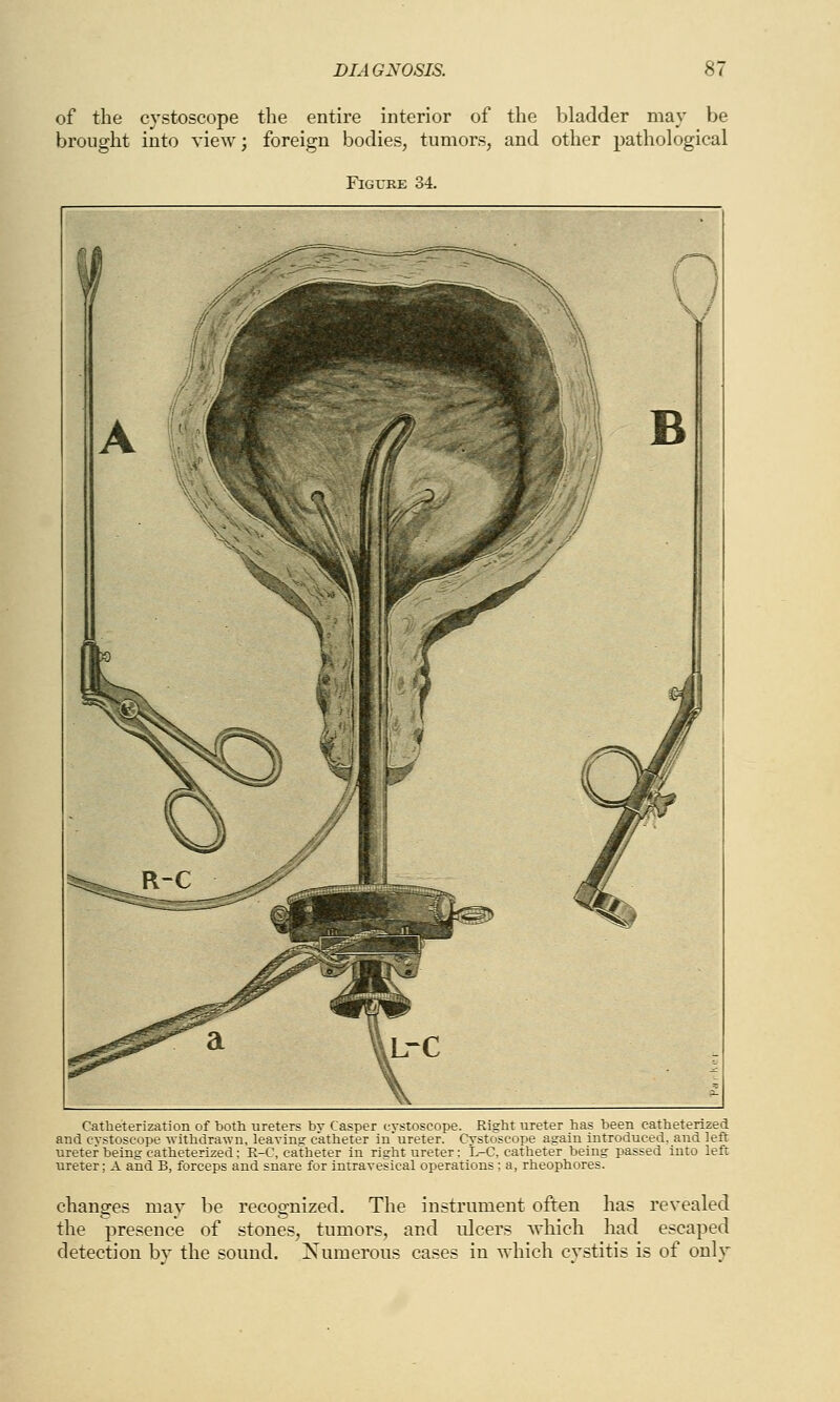 of the cystoscope the entire interior of the bladder may be brought into view; foreign bodies, tumors, and other pathological Figure 34. Catheterization of both ureters by Casper cystoscope. Right ureter has been catheterized and cvstoseope -withdrawn, leaving catheter in'ureter. Cystoscope again introduced, and left ureter being catheterized; R-C, catheter in right ureter: L-C, catheter being passed into left ureter; A and B, forceps and snare for intravesical operations; a, rheophores. changes may be recognized. The instrument often has revealed the presence of stones, tumors, and ulcers which had escaped detection by the sound. Numerous cases in which cystitis is of only