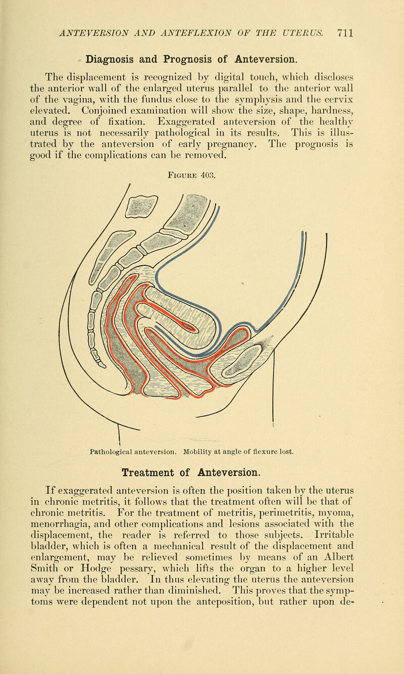 Diagnosis and Prognosis of Anteversion. The displacement is recognized by digital touch, which discloses the anterior wall of the enlarged uterus parallel to the anterior wall of the vagina, with the fundus close to the symphysis and the cervix elevated. Conjoined examination will show the size, shape, hardness, and degree of fixation. Exaggerated anteversion of the healthy uterus is not necessarily pathological in its results. This is illus- trated by the anteversion of early pregnancy. The prognosis is good if the complications can be removed. Figure 403. Pathological anteversion. Mobility at angle of flexure lost. Treatment of Anteversion. If exaggerated anteversion is often the position taken by the uterus in chronic metritis, it follows that the treatment often will be that of chronic metritis. For the treatment of metritis, perimetritis, myoma, menorrhagia, and other complications and lesions associated with the displacement, the reader is referred to those subjects. Irritable bladder, which is often a mechanical result of the displacement and enlargement, may be relieved sometimes by means of an Albert Smith or Hodge pessary, which lifts the organ to a higher level away from the bladder. In thus elevating the uterus the anteversion may be increased rather than diminished. This proves that the symp- toms were dependent not upon the anteposition, but rather upon de-