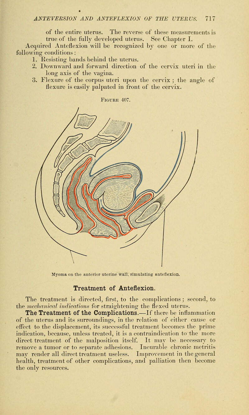 of the entire uterus. The reverse of these measurements is true of the fully developed uterus. See Chapter I. Acquired Anteflexion will be recognized by one or more of the followinu conditions: 1. Resisting bands behind the uterus. 2. Downward and forward direction of the cervix uteri in the long axis of the vagina. 3. Flexure of the corpus uteri upon the cervix ; the angle of flexure is easily palpated in front of the cervix. Figure 407. Myoma on the anterior uterine wall, simulating anteflexion. Treatment of Anteflexion. The treatment is directed, first, to the complications; second, to the mechanical indications for straightening the flexed uterus. The Treatment of the Complications.—If there be inflammation of the uterus and its surroundings, in the relation of either cause or effect to the displacement, its successful treatment becomes the prime indication, because, unless treated, it is a contraindication to the more direct treatment of the malposition itself. It may be necessary to remove a tumor or to separate adhesions. Incurable chronic metritis may render all direct treatment useless. Improvement in the general health, treatment of other complications, and palliation then become the only resources.