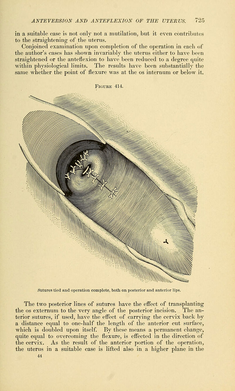 in a suitable case is not only not a mutilation, but it even contributes to the straightening of the uterus. Conjoined examination upon completion of the operation in each of the author's cases has shown invariably the uterus either to have been straightened or the anteflexion to have been reduced to a degree quite within physiological limits. The results have been substantially the same whether the point of flexure was at the os internum or below it. Figure 414. Sutures tied and operation complete, both on posterior and anterior lips. The two posterior lines of sutures have the effect of transplanting the os externum to the very angle of the posterior incision. The an- terior sutures, if used, have the effect of carrying the cervix back by a distance equal to one-half the length of the anterior cut surface, which is doubled upon itself. By these means a permanent change, quite equal to overcoming the flexure, is effected in the direction of the cervix. As the result of the anterior portion of the operation, the uterus in a suitable case is lifted also in a higher plane in the 44