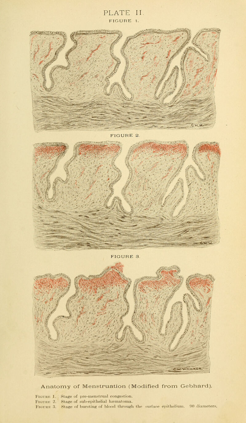 PLATE II. FIGURE 1. Iff FIGURE 2 FIGURE 3. * T;*it*jC*« 3^i*» Anatomy of Menstruation (Modified fronn Gebhard). Figure 1. Stage of pre-menstrual congestion. Figure 2. Stage of sub-epithelial haematoma. Figure 3. Stage of bursting of blood through the surface ei>ithelium. 90 diameters.