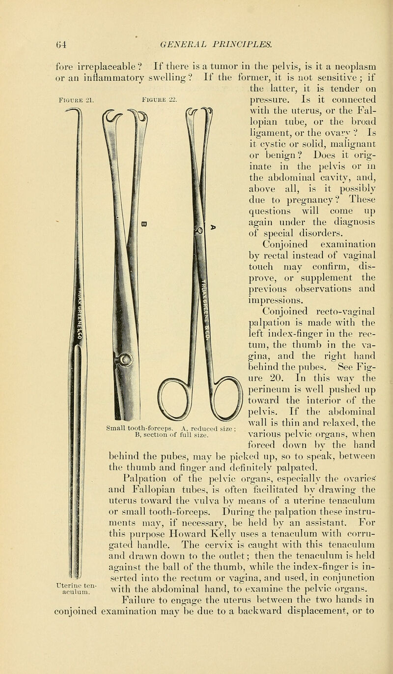 fore irreplaceable ? If there is a tumor in the pelvis, is it a neoplasm or an inflammatory swelling? If the former, it is not sensitive; if the latter, it is tender on Figure 21. Figure 22 Uterine ten aculum. pressure. Is it connected **-% /?■ *^&\ (^T IIs) w^ ^ne uterus> or tne -^a^~ I it I / Yt f/ lopian tube, or the broad ligament, or the ovary ? Is it cystic or solid, malignant or benign ? Does it orig- inate in the pelvis or in the abdominal cavity, and, above all, is it possibly due to pregnancy? These questions will come up again under the diagnosis of special disorders. Conjoined examination by rectal instead of vaginal touch may confirm, dis- prove, or supplement the previous observations and impressions. Conjoined recto-vaginal palpation is made with the left index-finger in the rec- tum, the thumb in the va- gina, and the right hand behind the pubes. See Fig- ure 20. In this way the perineum is well pushed up toward the interior of the pelvis. If the abdominal wall is thin and relaxed, the various pelvic organs, when forced down by the hand behind the pubes, may be picked up, so to speak, between the thumb and finger and definitely palpated. Palpation of the pelvic organs, especially the ovaries' and Fallopian tubes, is often facilitated by drawing the uterus toward the vulva by means of a uterine tenaculum or small tooth-forceps. During the palpation these instru- ments may, if necessary, be held by an assistant. For this purpose Howard Kelly uses a tenaculum with corru- gated handle. The cervix is caught with this tenaculum and drawn down to the outlet; then the tenaculum is held against the ball of the thumb, while the index-finger is in- serted into the rectum or vagina, and used, in conjunction with the abdominal hand, to examine the pelvic organs. Failure to engage the uterus between the two hands in conjoined examination may be due to a backward displacement, or to Small tooth-forceps. A, reduced size ; B, section of full size.