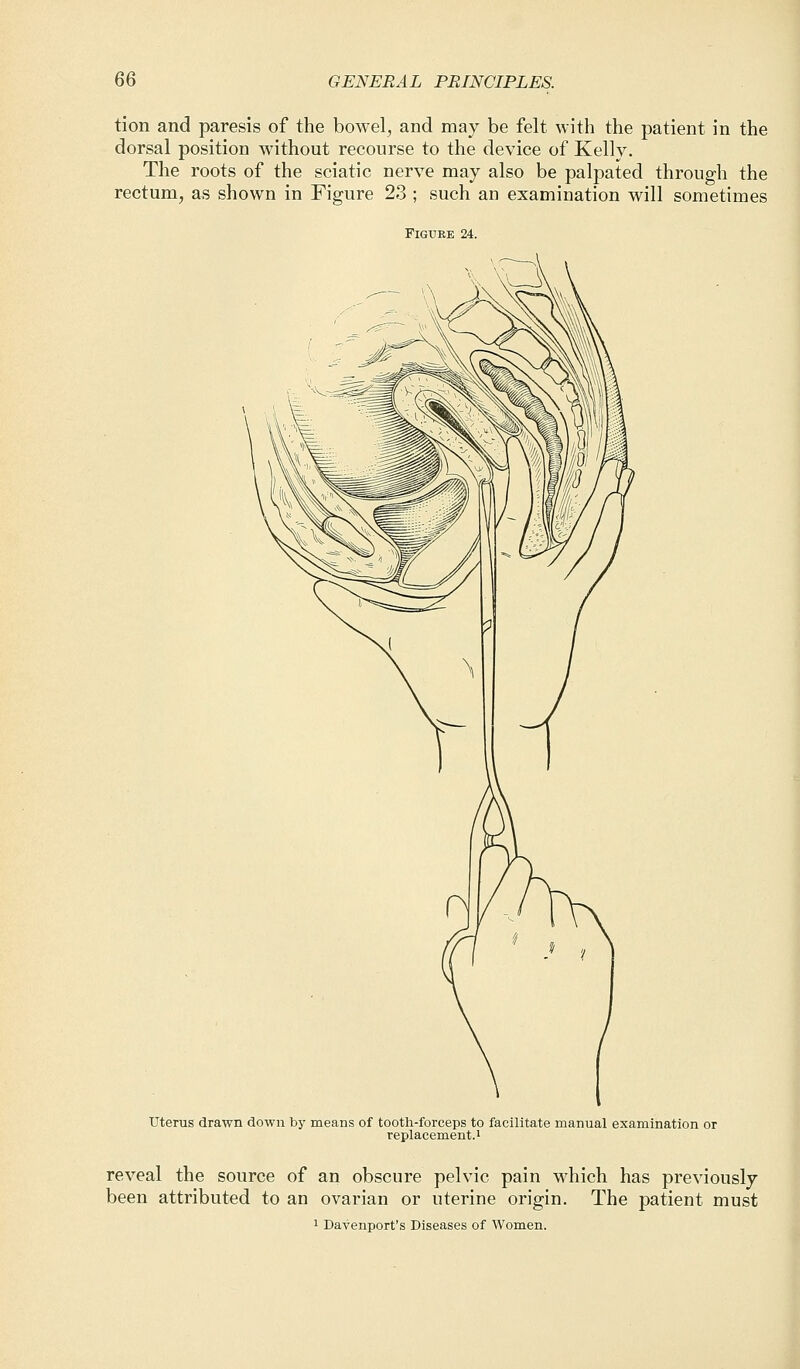 tion and paresis of the bowel, and may be felt with the patient in the dorsal position without recourse to the device of Kelly. The roots of the sciatic nerve may also be palpated through the rectum, as shown in Figure 23 ; such an examination will sometimes FlGUEE 24. Uterus drawn down by means of tooth-forceps to facilitate manual examination or replacement.1 reveal the source of an obscure pelvic pain which has previously been attributed to an ovarian or uterine origin. The patient must