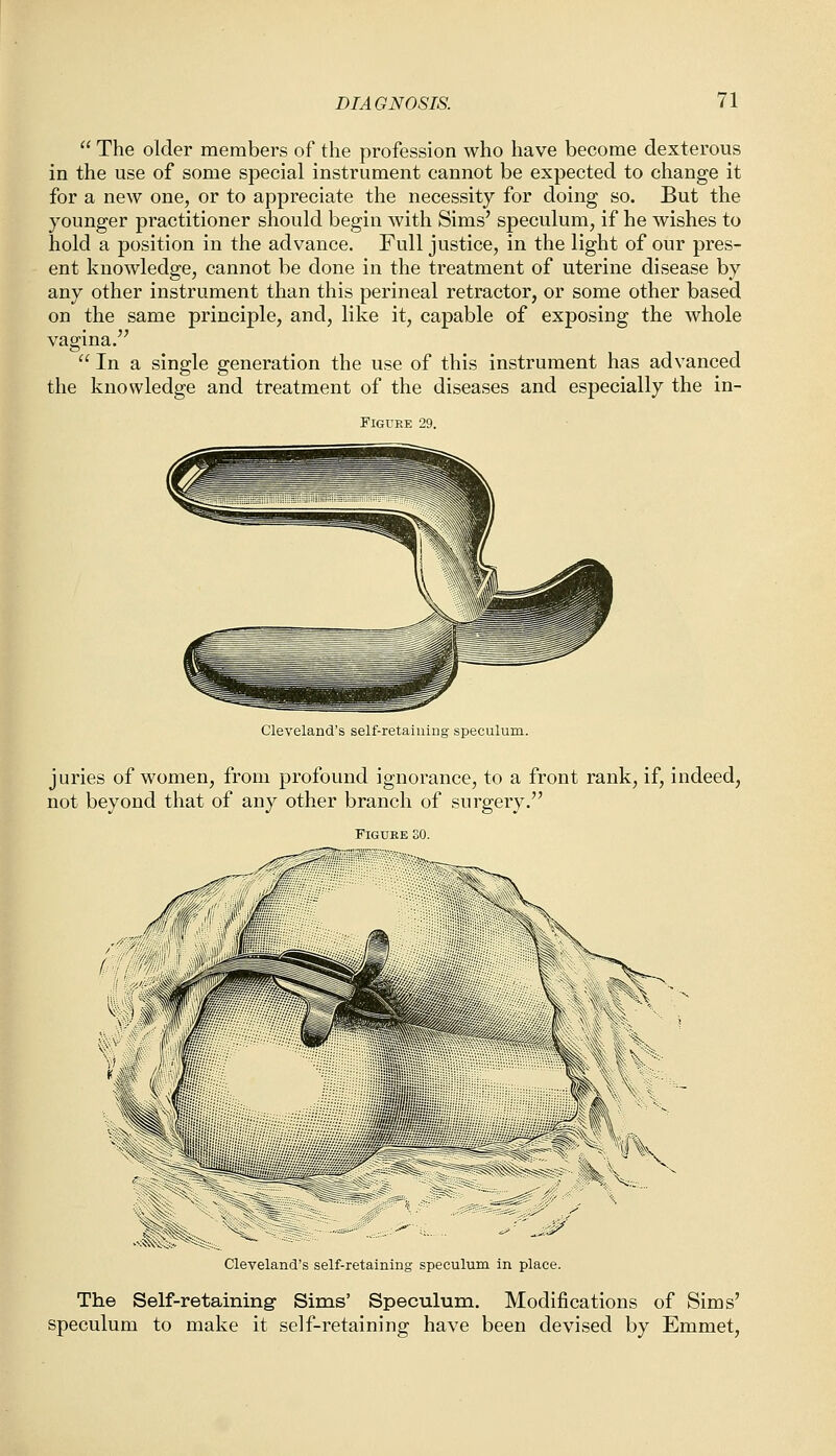  The older members of the profession who have become dexterous in the use of some special instrument cannot be expected to change it for a new one, or to appreciate the necessity for doing so. But the younger practitioner should begin with Sims' speculum, if he wishes to hold a position in the advance. Full justice, in the light of our pres- ent knowledge, cannot be done in the treatment of uterine disease by any other instrument than this perineal retractor, or some other based on the same principle, and, like it, capable of exposing the whole vagina.  In a single generation the use of this instrument has advanced the knowledge and treatment of the diseases and especially the in- FlGUEE 29. Cleveland's self-retaining speculum. juries of women, from profound ignorance, to a front rank, if, indeed, not beyond that of any other branch of surgery. Figure 30. Cleveland's self-retaining speculum in place. The Self-retaining Sims' Speculum. Modifications of Sims' speculum to make it self-retaining have been devised by Emmet,