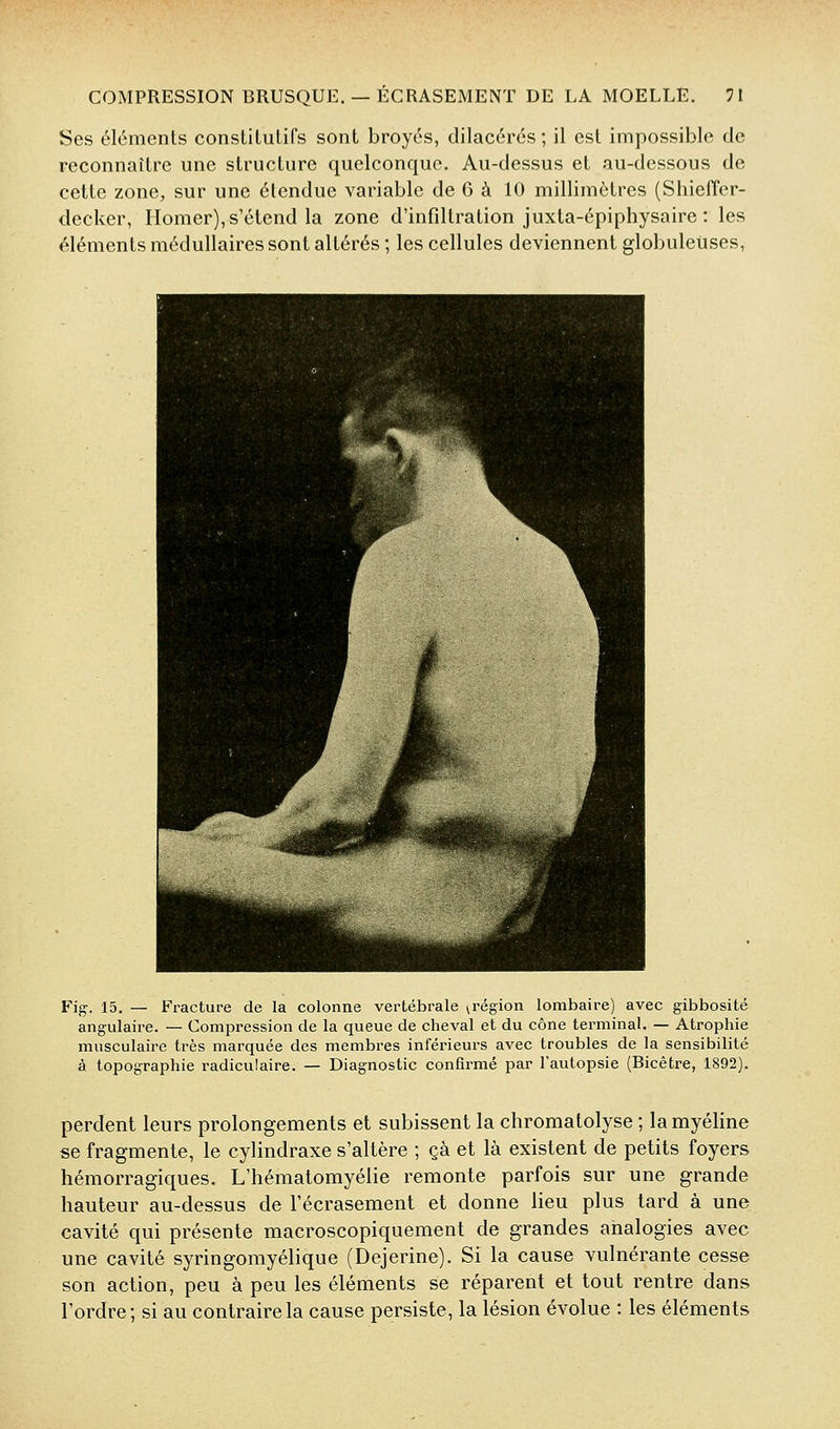 Ses éléments constitutifs sont broyés, dilacérés ; il est impossible de reconnaître une structure quelconque. Au-dessus et au-dessous de cette zone, sur une étendue variable de G à 10 millimètres (Shiefïer- decker, Ilomer), s'étend la zone d'infdtration juxta-épiphysaire : les éléments médullaires sont altérés ; les cellules deviennent globuleuses, Fig. 15. — Fracture de la colonne vertébrale ^région lombaire) avec gibbosité angulaire. — Compression de la queue de cheval et du cône terminal. — Atrophie musculaire très marquée des membres inférieurs avec troubles de la sensibilité à topographie radiculaire. — Diagnostic confirmé par l'autopsie (Bicêtre, 1892). perdent leurs prolongements et subissent la chromatolyse ; la myéline se fragmente, le cylindraxe s'altère ; çà et là existent de petits foyers hémorragiques. L'hématomyélie remonte parfois sur une grande hauteur au-dessus de l'écrasement et donne lieu plus tard à une cavité qui présente macroscopiquement de grandes analogies avec une cavité syringomyélique (Dejerine). Si la cause vulnérante cesse son action, peu à peu les éléments se réparent et tout rentre dans l'ordre; si au contraire la cause persiste, la lésion évolue : les éléments
