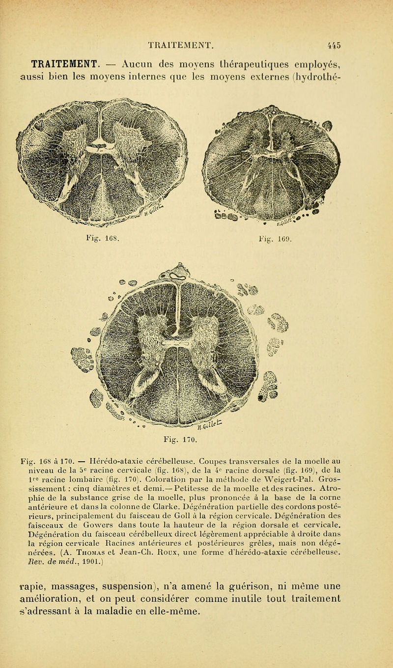 TRAITEMENT. 4^5 TRAITEMENT. — Aucun des moyens Ihérapeuliqucs employés, aussi bien les moyens internes que les moyens externes (liydrothé- Fig. 170. Fig. 168 à 170. — Hérédo-ataxie cérébelleuse. Coupes transversales de la moelle au niveau de la 5^ racine cervicale (fig. 168), de la 4^ racine dorsale (fig. 169), de la l^e racine lombaire (fig. 170). Coloration par la méthode de Weigert-Pal. Gros- sissement : cinq diamètres et demi.— Petitesse de la moelle et des racines. Atro- phie de la substance grise de la moelle, plus prononcée à la base de la corne antérieure et dans la colonne de Glarke. Dégénération partielle des cordons posté- rieurs, principalement du faisceau de Goll à la région cervicale. Dégénération des faisceaux de Gowers dans toute la hauteur de la région dorsale et cervicale. Dégénération du faisceau cérébelleux direct légèrement appréciable à droite dans la région cervicale Racines antérieures et postérieures grêles, mais non dégé- nérées. (A. Thomas et Jean-Ch. Roux, une forme d'hérédo-ataxie cérébelleuse. Rev. de méd., 1901.) rapie, massages, suspension), n'a amené la g-uérison, ni même une amélioration, et on peut considérer comme inutile tout traitement s'adressant à la maladie en elle-même.