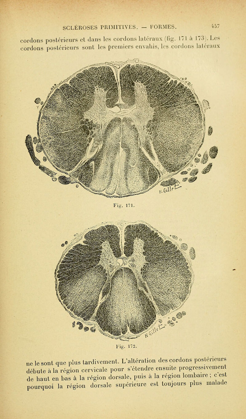 cordons postérieurs et dans les cordons latéraux (fig-. 171 à i73j. Les cordons postérieurs sont les premiers envahis, les cordons latéraux Fiff. 171. Fis-. 172. ne le sont que plus tardivement. L'altération des cordons postérieurs débute à la région cervicale pour s'étendre ensuite progressivement de haut en bas à la région dorsale, puis à la région lombaire ; c est pourquoi la région dorsale supérieure est toujours plus malade