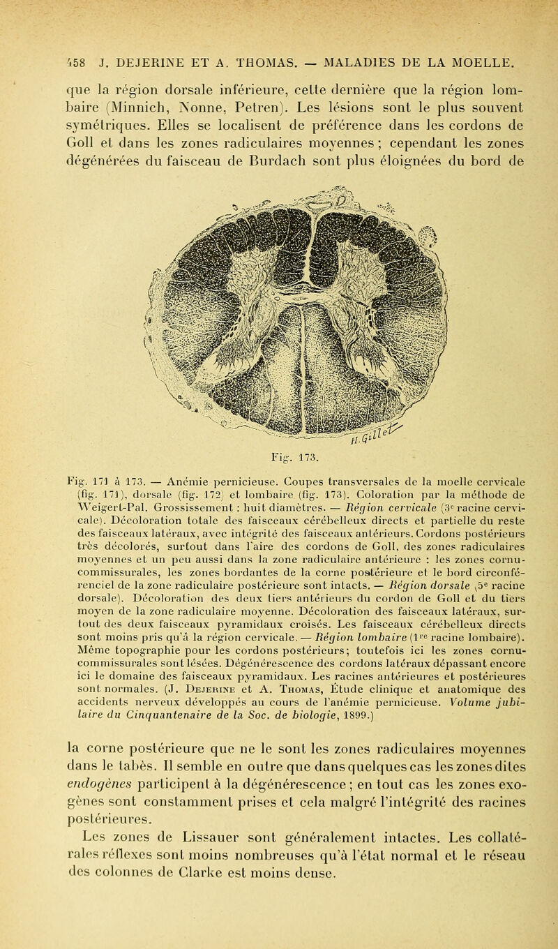 que la région dorsale inférieure, celte dernière que la région lom- baire (Minnich, Nonne, Pelren). Les lésions sont le plus souvent symétriques. Elles se localisent de préférence dans les cordons de Goll et dans les zones radiculaires moyennes ; cependant les zones dégénérées du faisceau de Burdach sont plus éloignées du bord de Fig. 173. Fig. 171 à 173. — Anémie pernicieuse. Coupes transversales de la moelle corvicale (fig. 171), dorsale (fig. 172) et lombaire (fig. 173). Coloration par la méthode de Weigert-Pal. Grossissement ; huit diamètres- — Région cervicale (3 racine cervi- cale). Décoloration totale des faisceaux cérébelleux directs et partielle du reste des faisceaux latéraux, avec intégrité des faisceaux antérieurs. Cordons postérieurs très décolorés, surtout dans Taire des cordons de Goll, des zones radiculaires moyennes et un peu aussi dans la zone radiculaire antérieure : les zones cornu- commissurales, les zones bordantes de la corne postérieure et le bord circonfé- renciel de la zone radiculaire postérieure sont intacts. — Région dorsale ^5^ racine dorsale). Décoloration des deux tiers antérieurs du cordon de Goll et du tiers moyen de la zone radiculaire moyenne. Décoloration des faisceaux latéraux, sur- tout des deux faisceaux pyramidaux croisés. Les faisceaux cérébelleux directs sont moins pris qu'à la région cervicale. — Région lombaire (l'^ racine lombaire). Même topographie pour les cordons postérieurs; toutefois ici les zones cornu- commissurales sont lésées. Dégénérescence des cordons latéraux dépassant encore ici le domaine des faisceaux pyramidaux. Les racines antérieures et postérieures sont normales. (J, Dejerine et A. Thomas, Étude clinique et anatomique des accidents nerveux développés au cours de Tanémie pernicieuse. Volume jubi- laire du Cinquantenaire de la Soc. de biologie, 1899.) la corne postérieure que ne le sont les zones radiculaires moyennes dans le tabès. Il semble en outre que dans quelques cas les zones dites endogènes participent à la dégénérescence ; en tout cas les zones exo- gènes sont constamment prises et cela malgré l'intégrité des racines postérieures. Les zones de Lissauer sont généralement intactes. Les collaté- rales réflexes sont moins nombreuses qu'à l'état normal et le réseau des colonnes de Glarke est moins dense.