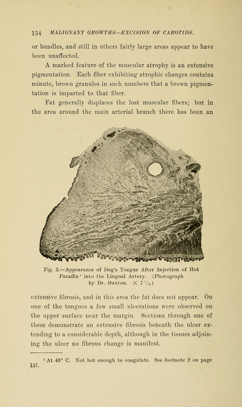 or bundles, and still in others fairly large areas appear to have been unaffected. A marked feature of the muscular atrophy is an extensive pigmentation. Each fiber exhibiting atrophic changes contains minute, brown granules in such numbers that a brown pigmen- tation is imparted to that fiber. Fat generally displaces the lost muscular fibers; but in the area around the main arterial branch there has been an Fig. 3.—Appearance of Dog's Tongue After Injection of Hot Paraffin l into the Lingual Artery. (Photograph by Dr. Buxton. X 7 'A-) extensive fibrosis, and in this area the fat does not appear. On one of the tongues a few small ulcerations were observed on the upper surface near the margin. Sections through one of these demonstrate an extensive fibrosis beneath the ulcer ex- tending to a considerable depth, although in the tissues adjoin- ing the ulcer no fibrous change is manifest. 157. 1 At 49° C. Not hot enough to coagulate. See footnote 2 on page