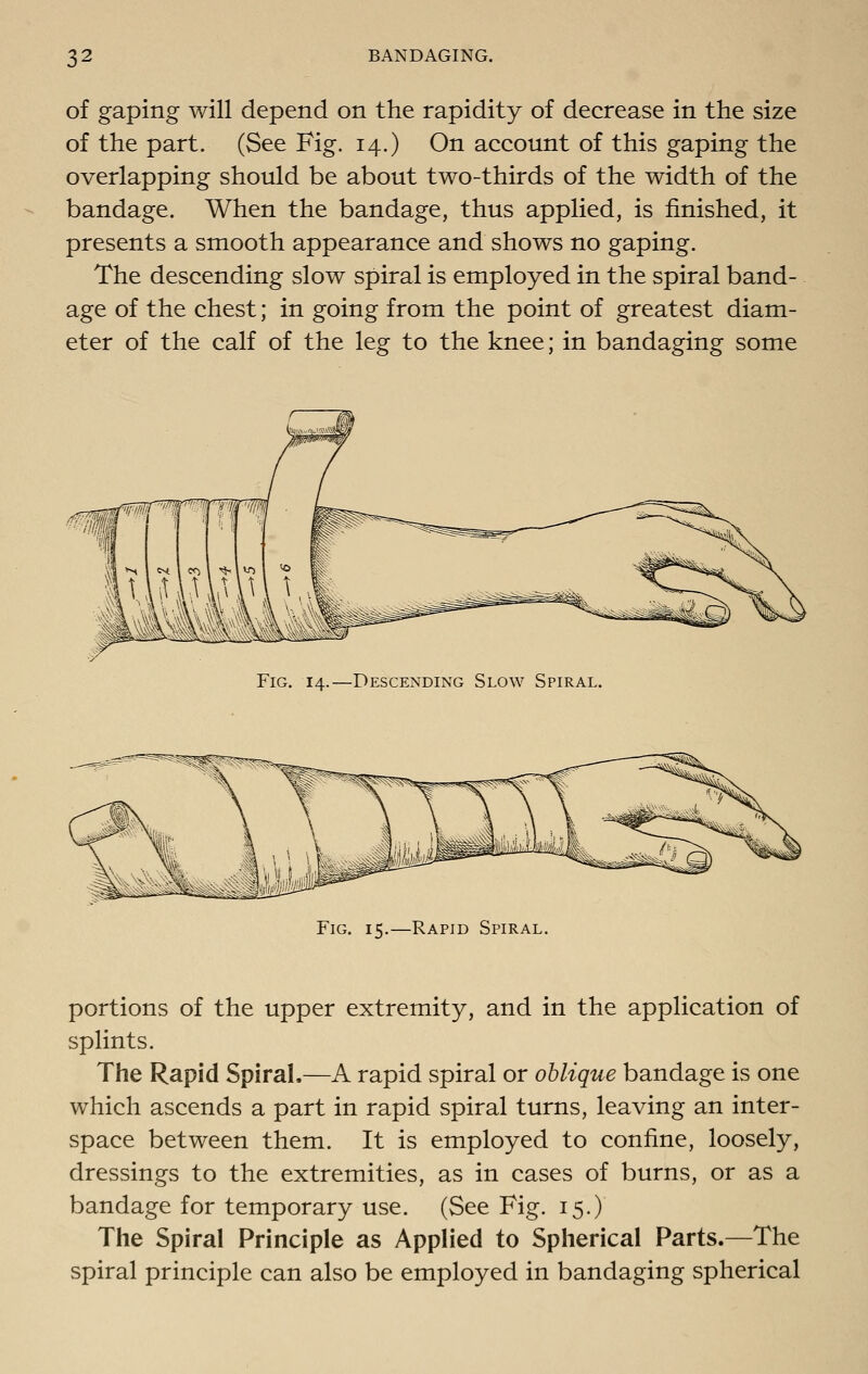 of gaping will depend on the rapidity of decrease in the size of the part. (See Fig. 14.) On account of this gaping the overlapping should be about two-thirds of the width of the bandage. When the bandage, thus applied, is finished, it presents a smooth appearance and shows no gaping. The descending slow spiral is employed in the spiral band- age of the chest; in going from the point of greatest diam- eter of the calf of the leg to the knee; in bandaging some Fig. 14.—Descending Slow Spiral. Fig. 15.—Rapid Spiral, portions of the upper extremity, and in the application of splints. The Rapid Spiral.—A rapid spiral or oblique bandage is one which ascends a part in rapid spiral turns, leaving an inter- space between them. It is employed to confine, loosely, dressings to the extremities, as in cases of burns, or as a bandage for temporary use. (See Fig. 15.) The Spiral Principle as Applied to Spherical Parts.—The spiral principle can also be employed in bandaging spherical