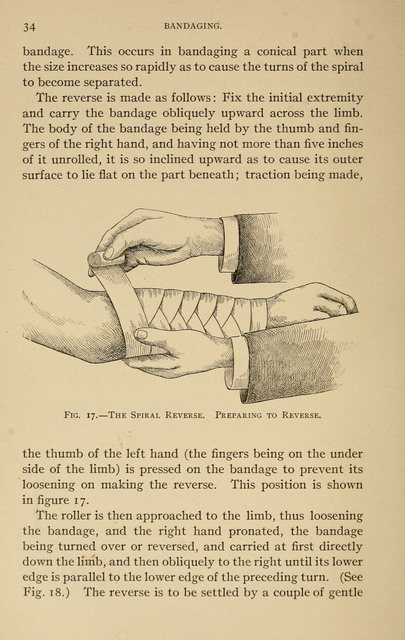 bandage. This occurs in bandaging a conical part when the size increases so rapidly as to cause the turns of the spiral to become separated. The reverse is made as follows: Fix the initial extremity and carry the bandage obliquely upward across the limb. The body of the bandage being held by the thumb and fin- gers of the right hand, and having not more than five inches of it unrolled, it is so inclined upward as to cause its outer surface to lie flat on the part beneath; traction being made. Fig. 17.—The Spiral Reverse. Preparing to Reverse. the thumb of the left hand (the fingers being on the under side of the limb) is pressed on the bandage to prevent its loosening on making the reverse. This position is shown in figure 17. The roller is then approached to the limb, thus loosening the bandage, and the right hand pronated, the bandage being turned over or reversed, and carried at first directly down the limb, and then obliquely to the right until its lower edge is parallel to the lower edge of the preceding turn. (See Fig. 18.) The reverse is to be settled by a couple of gentle