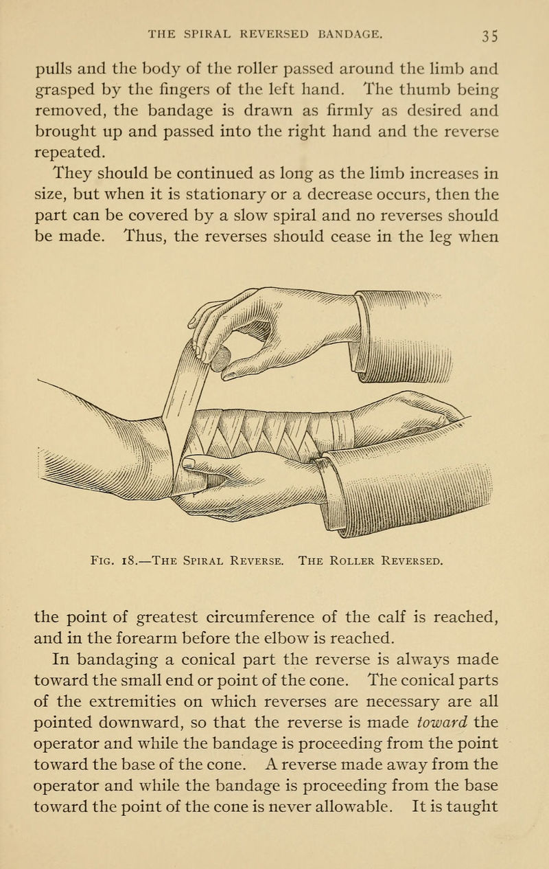 pulls and the body of the roller passed around the limb and grasped by the fingers of the left hand. The thumb being removed, the bandage is drawn as firmly as desired and brought up and passed into the right hand and the reverse repeated. They should be continued as long as the limb increases in size, but when it is stationary or a decrease occurs, then the part can be covered by a slow spiral and no reverses should be made. Thus, the reverses should cease in the leg when Fig. -The Spiral Reverse. The Roller Reversed. the point of greatest circumference of the calf is reached, and in the forearm before the elbow is reached. In bandaging a conical part the reverse is always made toward the small end or point of the cone. The conical parts of the extremities on which reverses are necessary are all pointed downward, so that the reverse is made toward the operator and while the bandage is proceeding from the point toward the base of the cone. A reverse made away from the operator and while the bandage is proceeding from the base toward the point of the cone is never allowable. It is taught