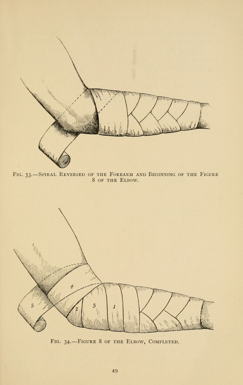 Fig. 33.—Spiral Reversed of the Forearm and Beginning of the Figure 8 OF THE Elbow. Fig. 34.—Figure 8 of the Elbow, Completed.