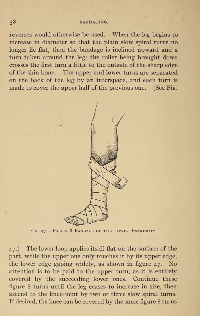 reverses would otherwise be used. When the leg begins to increase in diameter so that the plain slow spiral turns no longer lie flat, then the bandage is inclined upward and a turn taken around the leg; the roller being brought down crosses the first turn a little to the outside of the sharp edge of the shin bone. The upper and lower turns are separated on the back of the leg by an interspace, and each turn is made to cover the upper half of the previous one. (See Fig. Fig. 47.—Figure 8 Bandage of the Lower Extremity. 47.) The lower loop applies itself flat on the surface of the part, while the upper one only touches it by its upper edge, the lower edge gaping widely, as shown in figure 47. No attention is to be paid to the upper turn, as it is entirely covered by the succeeding lower ones. Continue these figure 8 turns until the leg ceases to increase in size, then ascend to the knee-joint by two or three slow spiral turns. If desired, the knee can be covered by the same figure 8 turns
