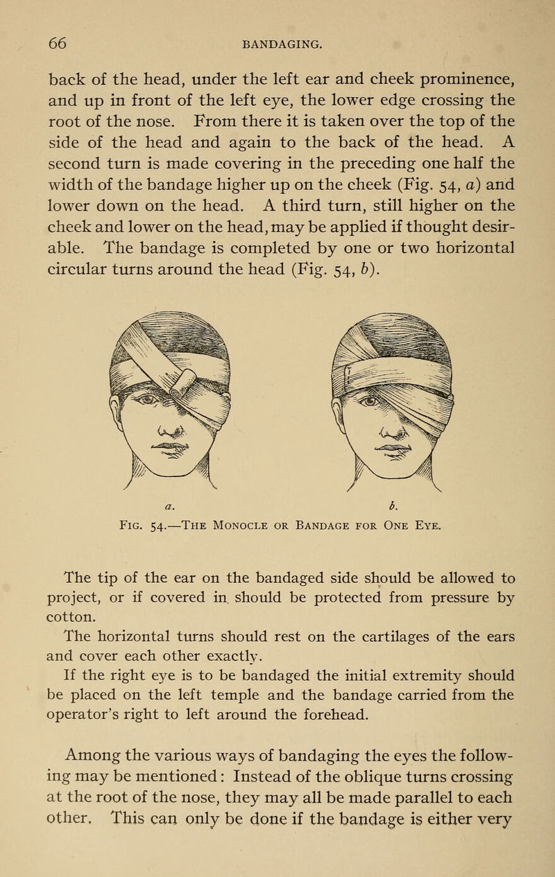 back of the head, under the left ear and cheek prominence, and up in front of the left eye, the lower edge crossing the root of the nose. From there it is taken over the top of the side of the head and again to the back of the head. A second turn is made covering in the preceding one half the width of the bandage higher up on the cheek (Fig. 54, a) and lower down on the head. A third turn, still higher on the cheek and lower on the head, may be applied if thought desir- able. The bandage is completed by one or two horizontal circular turns around the head (Fig. 54, b). a. b. Fig. 54.—The Monocle or Bandage for One Eye. The tip of the ear on the bandaged side should be allowed to project, or if covered in. should be protected from pressure by cotton. The horizontal turns should rest on the cartilages of the ears and cover each other exactly. If the right eye is to be bandaged the initial extremity should be placed on the left temple and the bandage carried from the operator's right to left around the forehead. Among the various ways of bandaging the eyes the follow- ing may be mentioned: Instead of the oblique turns crossing at the root of the nose, they may all be made parallel to each other. This can only be done if the bandage is either very