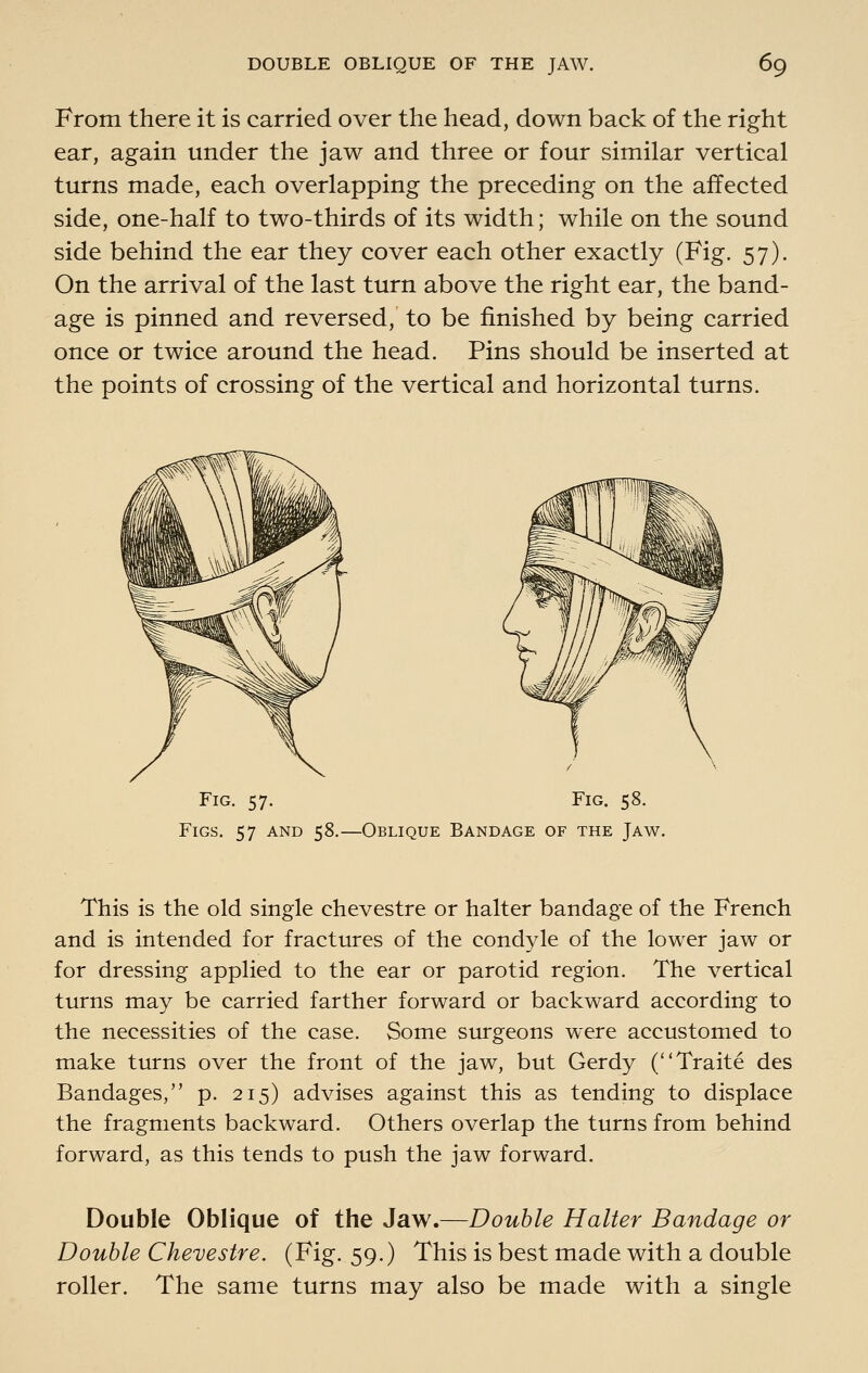 From there it is carried over the head, down back of the right ear, again under the jaw and three or four similar vertical turns made, each overlapping the preceding on the affected side, one-half to two-thirds of its width; while on the sound side behind the ear they cover each other exactly (Fig. 57). On the arrival of the last turn above the right ear, the band- age is pinned and reversed, to be finished by being carried once or twice around the head. Pins should be inserted at the points of crossing of the vertical and horizontal turns. Fig. 57. Fig. 58. Figs. 57 and 58.—Oblique Bandage of the Jaw. This is the old single chevestre or halter bandage of the French and is intended for fractures of the condyle of the lower jaw or for dressing applied to the ear or parotid region. The vertical turns may be carried farther forward or backward according to the necessities of the case. Some surgeons were accustomed to make turns over the front of the jaw, but Gerdy (Traite des Bandages, p. 215) advises against this as tending to displace the fragments backward. Others overlap the turns from behind forward, as this tends to push the jaw forward. Double Oblique of the Jaw.—Double Halter Bandage or Double Chevestre. (Fig. 59.) This is best made with a double roller. The same turns may also be made with a single