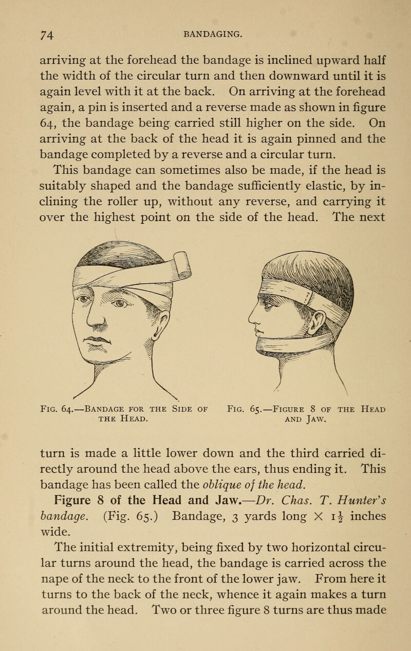 arriving at the forehead the bandage is inclined upward half the width of the circular turn and then downward until it is again level with it at the back. On arriving at the forehead again, a pin is inserted and a reverse made as shown in figure 64, the bandage being carried still higher on the side. On arriving at the back of the head it is again pinned and the bandage completed by a reverse and a circular turn. This bandage can sometimes also be made, if the head is suitably shaped and the bandage sufficiently elastic, by in- clining the roller up, without any reverse, and carrying it over the highest point on the side of the head. The next Fig. 64.—Bandage for the Side of THE Head. Fig. 65. -Figure 8 of the Head AND Jaw. turn is made a little lower down and the third carried di- rectly around the head above the ears, thus ending it. This bandage has been called the oblique of the head. Figure 8 of the Head and Jaw.—Dr. Chas. T. Hunter's bandage. (Fig. 65.) Bandage, 3 yards long X ij inches wide. The initial extremity, being fixed by two horizontal circu- lar turns around the head, the bandage is carried across the nape of the neck to the front of the lower jaw. From here it turns to the back of the neck, whence it again makes a turn around the head. Two or three figure 8 turns are thus made