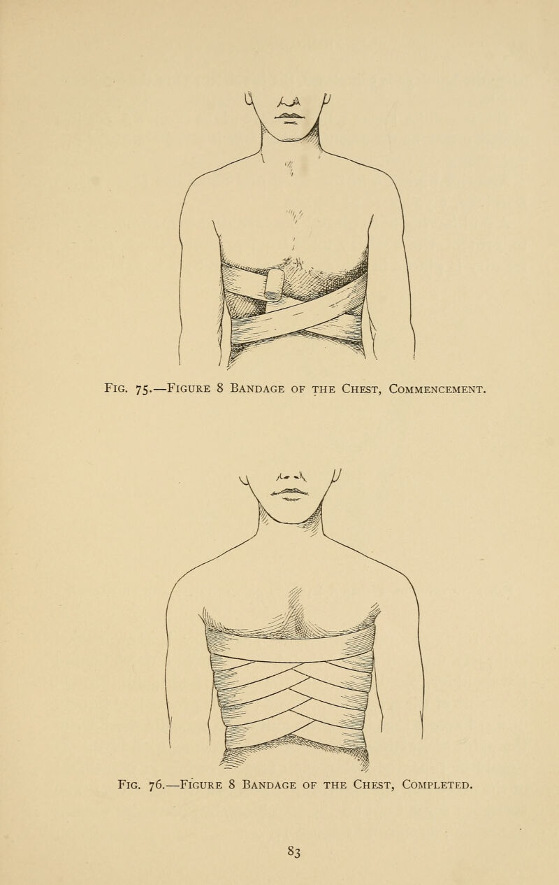 Fig. 75.—Figure 8 Bandage of the Chest, Commencement. Fig. 76.—Figure 8 Bandage of the Chest, Completed. ^3