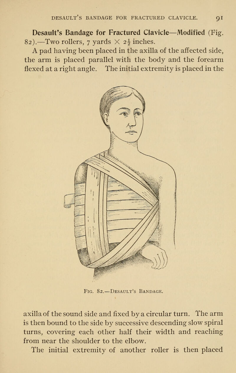 Desault's Bandage for Fractured Clavicle—Modified (Fig. 82).—Tvv^o rollers, 7 yards X 2^ inches. A pad having been placed in the axilla of the affected side, the arm is placed parallel v^ith the body and the forearm flexed at a right angle. The initial extremity is placed in the Fig. 82.—Desault's Bandage. axilla of the sound side and fixed by a circular turn. The arm is then bound to the side by successive descending slow spiral turns, covering each other half their v^idth and reaching from near the shoulder to the elbov^. The initial extremity of another roller is then placed