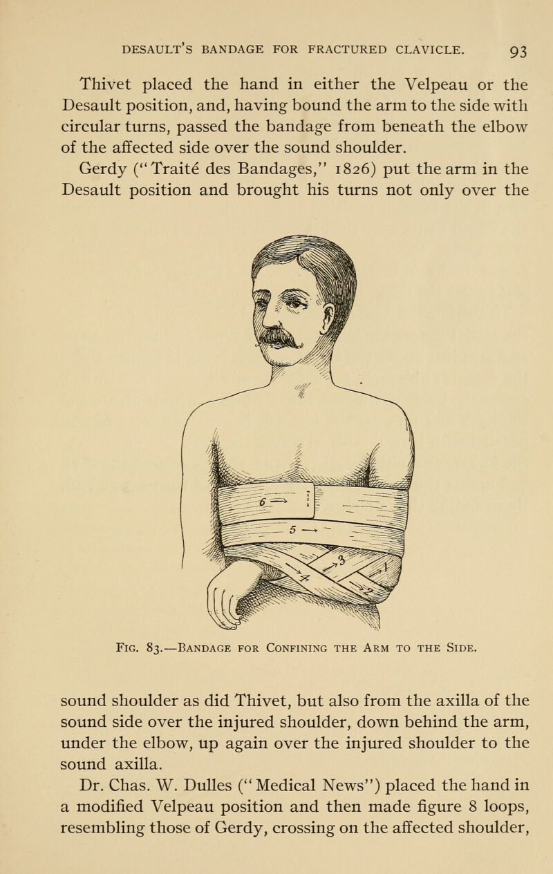 Thivet placed the hand in either the Velpeau or the Desault position, and, having bound the arm to the side with circular turns, passed the bandage from beneath the elbow of the affected side over the sound shoulder. Gerdy (Traite des Bandages, 1826) put the arm in the Desault position and brought his turns not only over the Fig. 83.—Bandage for Confining the Arm to the Side. sound shoulder as did Thivet, but also from the axilla of the sound side over the injured shoulder, down behind the arm, under the elbow, up again over the injured shoulder to the sound axilla. Dr. Chas. W. Dulles C' Medical News) placed the hand in a modified Velpeau position and then made figure 8 loops, resembling those of Gerdy, crossing on the affected shoulder.