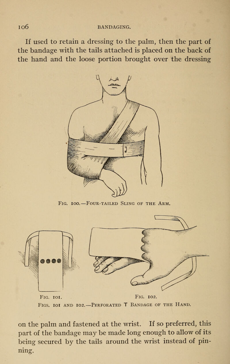 If used to retain a dressing to the palm, then the part of the bandage with the tails attached is placed on the back of the hand and the loose portion brought over the dressing Fig. ioo,—Four-tailed Sling of the Arm. Fig. ioi. F'ig. 102. Figs, ioi and 102.—Perforated T Bandage of the Hand. on the palm and fastened at the wrist. If so preferred, this part of the bandage may be made long enough to allow of its being secured by the tails around the wrist instead of pin- ning.