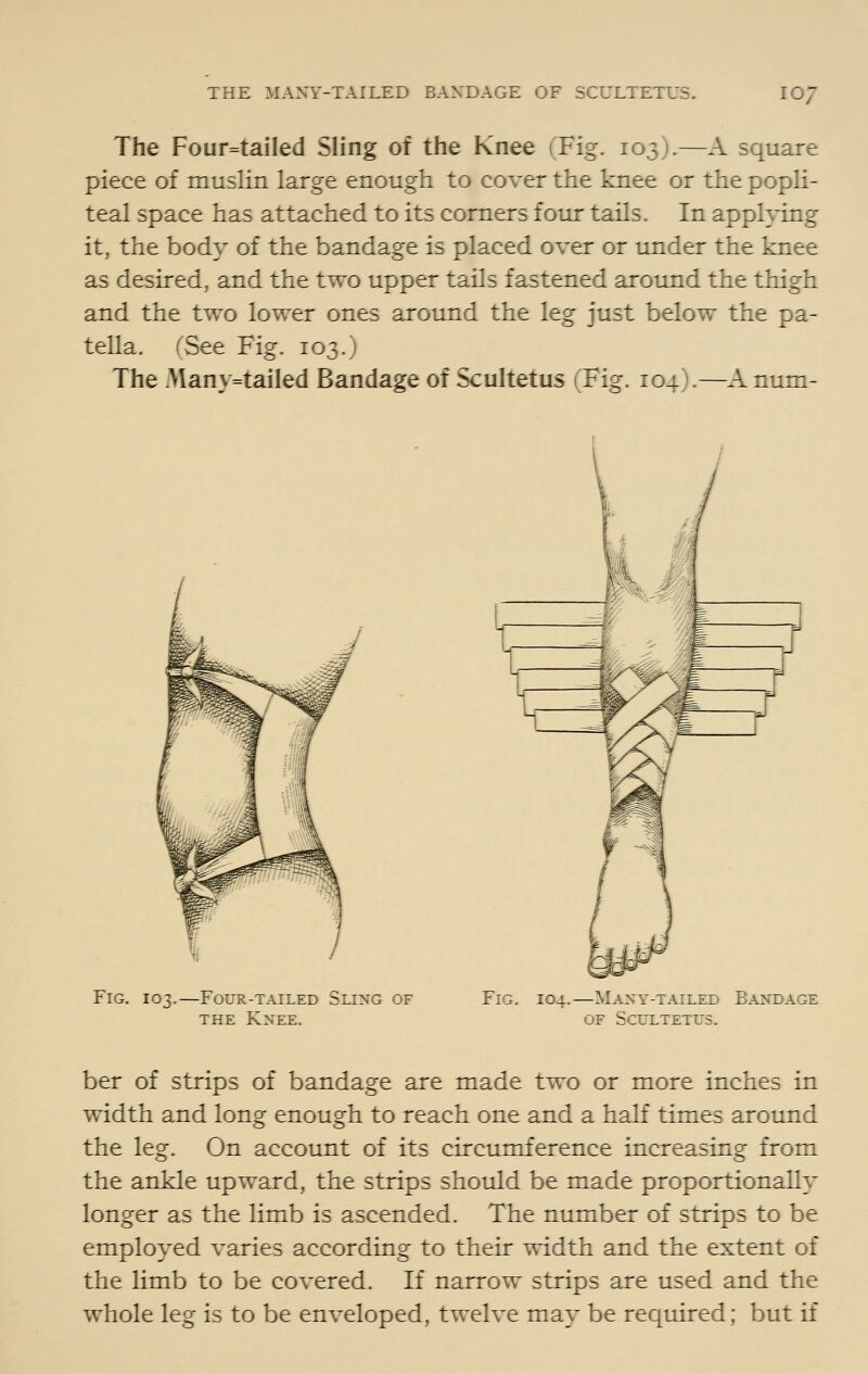 The Four=ta!led Sling of the Knee (Fig. 103).—A square piece of muslin large enough to cover the knee or the popli- teal space has attached to its comers four tails. In applying it, the body of the bandage is placed over or under the knee as desired, and the two upper tails fastened around the thigh and the two lower ones around the leg just below the pa- tella. (See Fig. 103.) The Many=tailed Bandage of Scultetus (Fig. 104).—A num- FiG. 103.—Four-tailed Sling of THE Knee. Fig. 104.—Many-tailed Bandage OF Scultetus. ber of strips of bandage are made two or more inches in width and long enough to reach one and a half times around the leg. On account of its circumference increasing from the ankle upward, the strips should be made proportionally longer as the limb is ascended. The number of strips to be employed varies according to their width and the extent of the limb to be covered. If narrow strips are used and the whole leg is to be enveloped, twelve may be required; but if