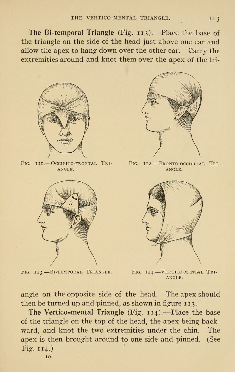 The Bi=temporal Triangle (Fig. 113).—Place the base of the triangle on the side of the head just above one ear and allow the apex to hang down over the other ear. Carry the extremities around and knot them over the apex of the tri- FlG. II. -OCCIPITO-FRONTAL TRI- ANGLE. Fig. ■Fronto-occipital Tri- angle. Fig. 113.—Bi-TEMPORAL Triangle. Fig. 114.—Vertico-mental Tri- angle. angle on the opposite side of the head. The apex should then be turned up and pinned, as shown in figure 113. The Vertico=mental Triangle (Fig. 114).—Place the base of the triangle on the top of the head, the apex being back- ward, and knot the two extremities under the chin. The apex is then brought around to one side and pinned. (See Fig. 114.)