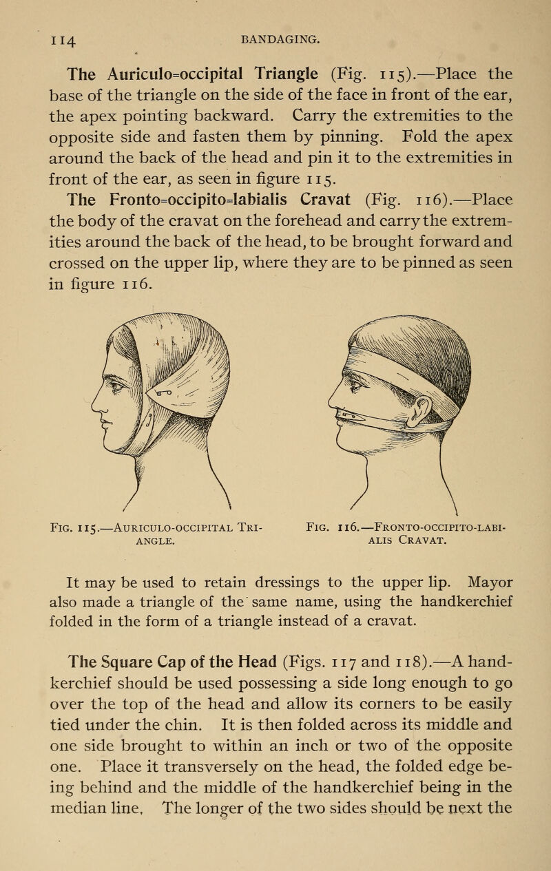 The Auriculo=occipital Triangle (Fig. 115).—Place the base of the triangle on the side of the face in front of the ear, the apex pointing backward. Carry the extremities to the opposite side and fasten them by pinning. Fold the apex around the back of the head and pin it to the extremities in front of the ear, as seen in figure 115. The Froiito=occipito=labialis Cravat (Fig. 116).—Place the body of the cravat on the forehead and carry the extrem- ities around the back of the head, to be brought forward and crossed on the upper lip, where they are to be pinned as seen in figure 116. Fig. 115.—AuRicuLO-occiPiTAL Tri- Fig. ii6.—Fronto-occipito-labi- ANGLE. ALIS CrAVAT. It may be used to retain dressings to the upper lip. Mayor also made a triangle of the same name, using the handkerchief folded in the form of a triangle instead of a cravat. The Square Cap of the Head (Figs. 117 and 118).—A hand- kerchief should be used possessing a side long enough to go over the top of the head and allow its corners to be easily tied under the chin. It is then folded across its middle and one side brought to within an inch or two of the opposite one. Place it transversely on the head, the folded edge be- ing behind and the middle of the handkerchief being in the median line. The longer of the two sides should be next the