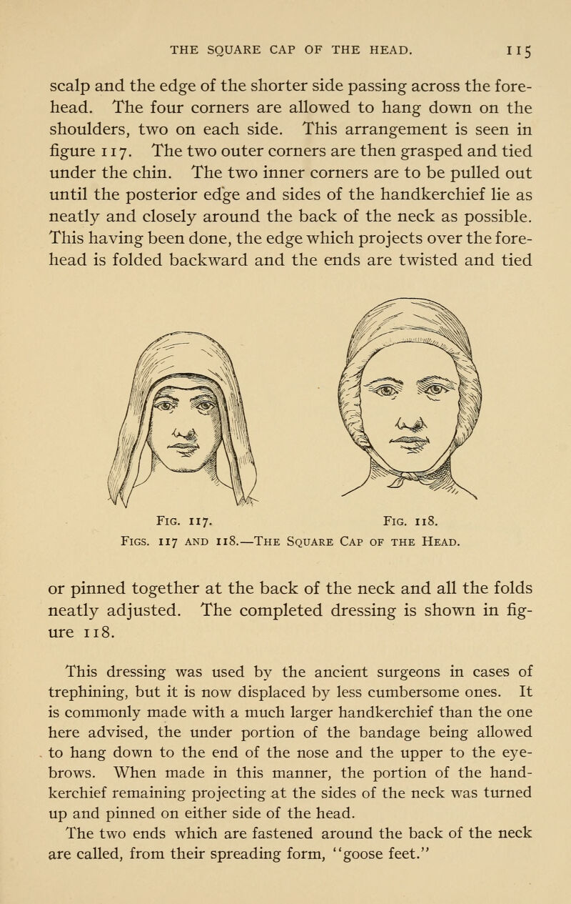 scalp and the edge of the shorter side passing across the fore- head. The four corners are allowed to hang down on the shoulders, two on each side. This arrangement is seen in figure 117. The two outer corners are then grasped and tied under the chin. The two inner corners are to be pulled out until the posterior edge and sides of the handkerchief lie as neatly and closely around the back of the neck as possible. This having been done, the edge which projects over the fore- head is folded backward and the ends are twisted and tied Fig. 117. Fig. 118. Figs. 117 and 118.—The Square Cap of the Head. or pinned together at the back of the neck and all the folds neatly adjusted. The completed dressing is shown in fig- ure 118. This dressing was used by the ancient surgeons in cases of trephining, but it is now displaced by less cumbersome ones. It is commonly made with a much larger handkerchief than the one here advised, the under portion of the bandage being allowed to hang down to the end of the nose and the upper to the eye- brows. When made in this manner, the portion of the hand- kerchief remaining projecting at the sides of the neck was turned up and pinned on either side of the head. The two ends which are fastened around the back of the neck are called, from their spreading form, goose feet.