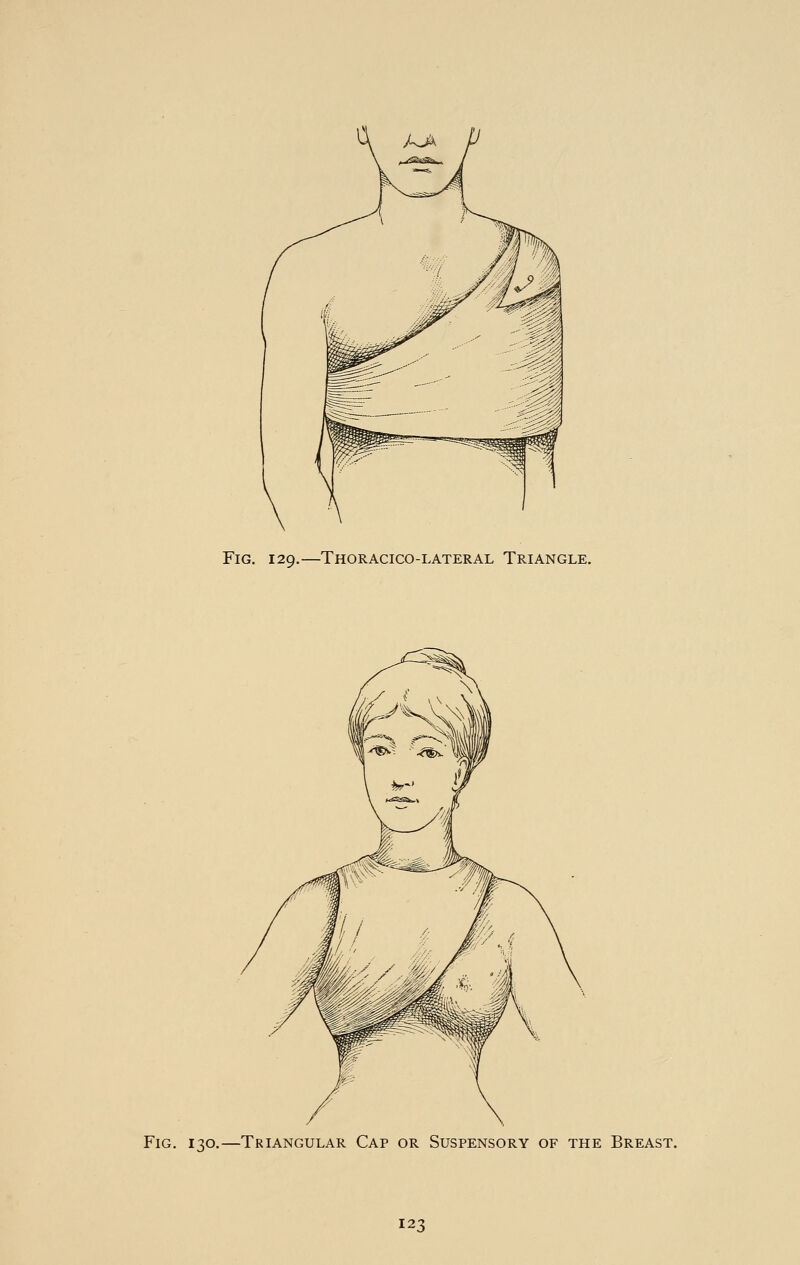 Fig. 129.—Thoracico-lateral Triangle. Fig. 130.—Triangular Cap or Suspensory of the Breast.