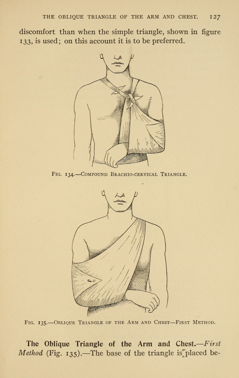 discomfort than when the simple triangle, shown in figure 133, is used; on this account it is to be preferred. Fig. 134.—Compound Brachio-cervical Triangle. Fig. 135.—Oblique Triangle of the Arm and Chest—First Method. The Oblique Triangle of the Arm and Chest.—First Method (Fig. 135),—The base of the triangle is^placed be-