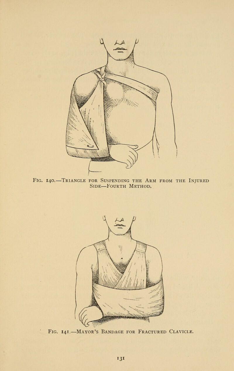 Fig. 140.—Triangle for Suspending the Arm from the Injured Side—Fourth Method. Fig. 141.—Mayor's Bandage for Fractured Clavicle. [31