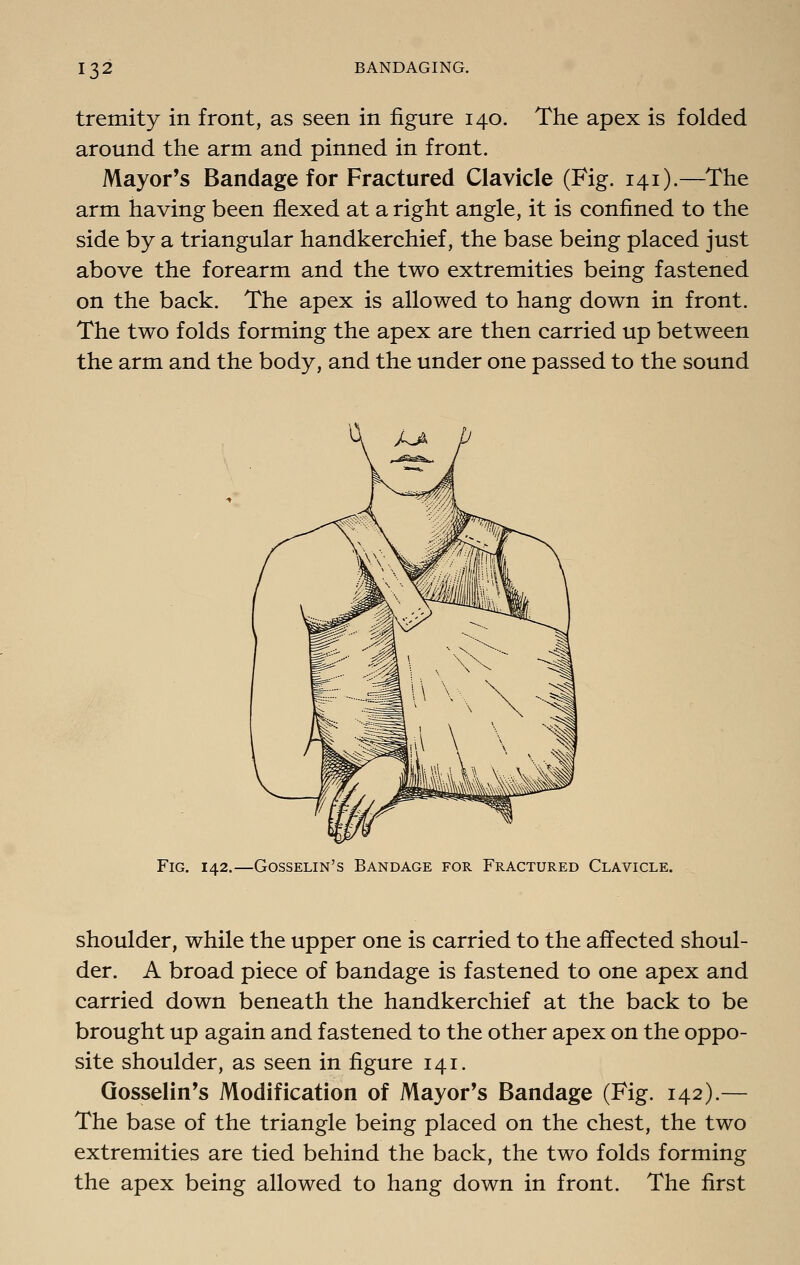 tremity in front, as seen in figure 140. The apex is folded around the arm and pinned in front. Mayor's Bandage for Fractured Clavicle (Fig. 141).—The arm having been flexed at a right angle, it is confined to the side by a triangular handkerchief, the base being placed just above the forearm and the two extremities being fastened on the back. The apex is allowed to hang down in front. The two folds forming the apex are then carried up between the arm and the body, and the under one passed to the sound Fig. 142.—Gosselin's Bandage for Fractured Clavicle. shoulder, while the upper one is carried to the affected shoul- der. A broad piece of bandage is fastened to one apex and carried down beneath the handkerchief at the back to be brought up again and fastened to the other apex on the oppo- site shoulder, as seen in figure 141. Gosselin's Modification of Mayor's Bandage (Fig. 142).— The base of the triangle being placed on the chest, the two extremities are tied behind the back, the two folds forming the apex being allowed to hang down in front. The first
