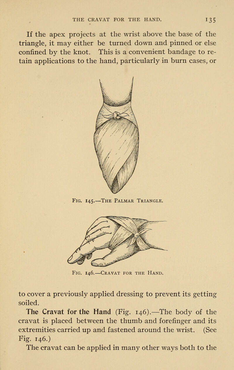 If the apex projects at the wrist above the base of the triangle, it may either be turned down and pinned or else confined by the knot. This is a convenient bandage to re- tain applications to the hand, particularly in burn cases, or Fig. 145.—The Palmar Triangle. Cravat for the Hand. to cover a previously applied dressing to prevent its getting soiled. The Cravat for the Hand (Fig. 146).—The body of the cravat is placed between the thumb and forefinger and its extremities carried up and fastened around the wrist. (See Fig. 146.) The cravat can be applied in many other ways both to the