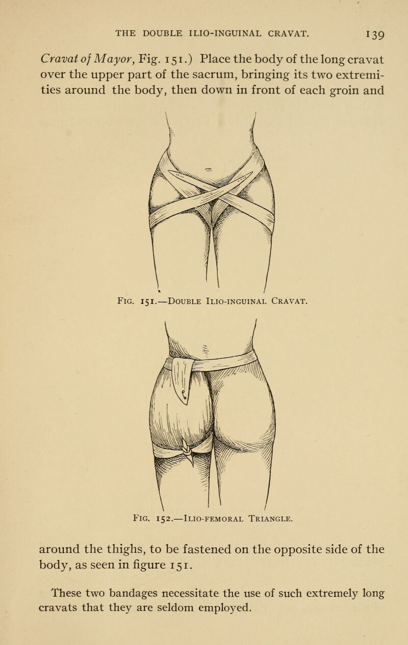 Cravat of Mayor, Fig. 151.) Place the body of the long cravat over the upper part of the sacrum, bringing its two extremi- ties around the body, then down in front of each groin and Fig. 151.—Double Ilio-inguinal Cravat. Fig. 152.—Ilio-femoral Triangle. around the thighs, to be fastened on the opposite side of the body, as seen in figure 151. These two bandages necessitate the use of such extremely long cravats that they are seldom employed.