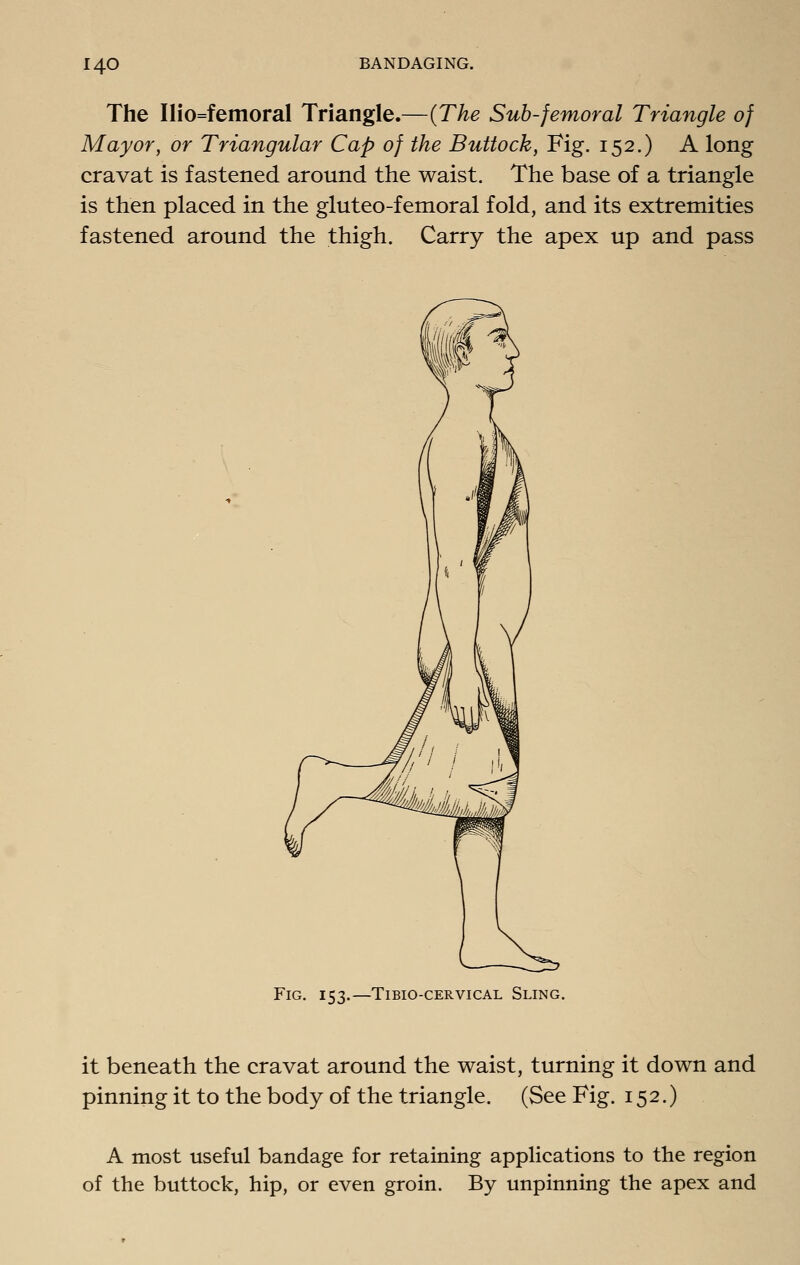 The Ilio=femoral Triangle.—{The Sub-femoral Triangle of Mayor, or Triangular Cap of the Buttock, Fig. 152.) A long cravat is fastened around the waist. The base of a triangle is then placed in the gluteo-femoral fold, and its extremities fastened around the thigh. Carry the apex up and pass Fig. 153.—TiBio-CERVicAL Sling. it beneath the cravat around the waist, turning it down and pinning it to the body of the triangle. (See Fig. 152.) A most useful bandage for retaining applications to the region of the buttock, hip, or even groin. By unpinning the apex and