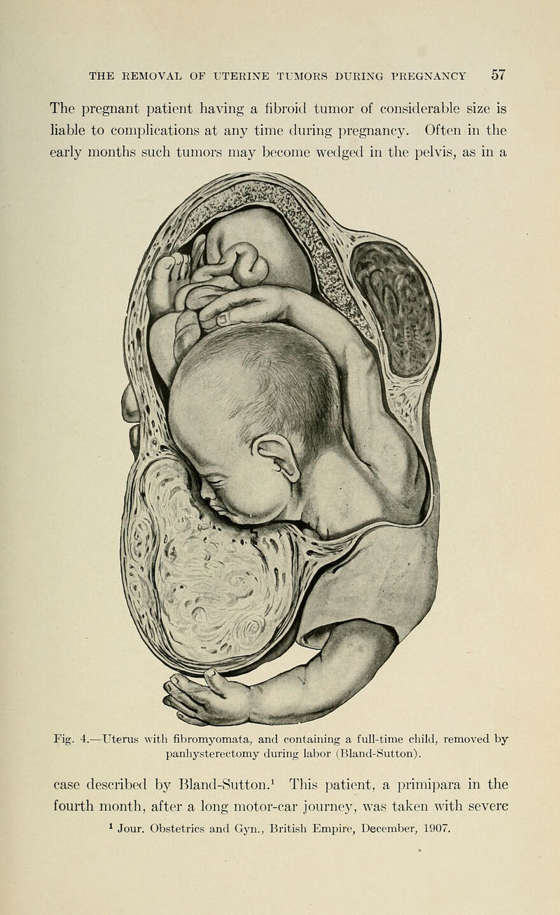 The pregnant patient having a fibroid tumor of considerable size is Hable to comphcations at any time during pregnancy. Often in the early months such tumors may become wedged in the pelvis, as in a Fig. 4.—Uterus with fibromyomata, and containing a full-time child, removed by panhysterectomy during labor (Bland-Sutton). case described by Bland-Sutton.^ This patient, a primipara in the fourth month, after a long motor-car journey, was taken with severe * Jour. Obstetrics and Gyn., British Empire, December, 1907.