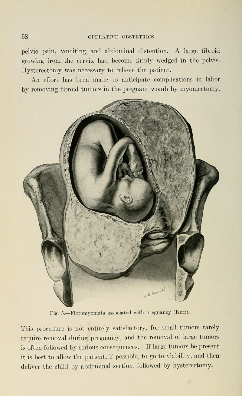 pelvic pain, vomiting, and abdominal distention. A large fibroid growing from the cervix had become firmly wedged in the pelvis. Hysterectomy was necessary to relieve the patient. An effort has been made to anticipate complications in labor by removing fibroid tumors in the pregnant womb by myomectomy. Fig. 5.—Fibromyomata associated with pregnancy (Kerr). This procedure is not entirely satisfactory, for small tumors rarely require removal during pregnancy, and the removal of large tumors is often followed by serious consequences. If large tumors be present it is best to allow the patient, if possible, to go to viability, and then deliver the child by abdominal section, followed by hysterectomy.