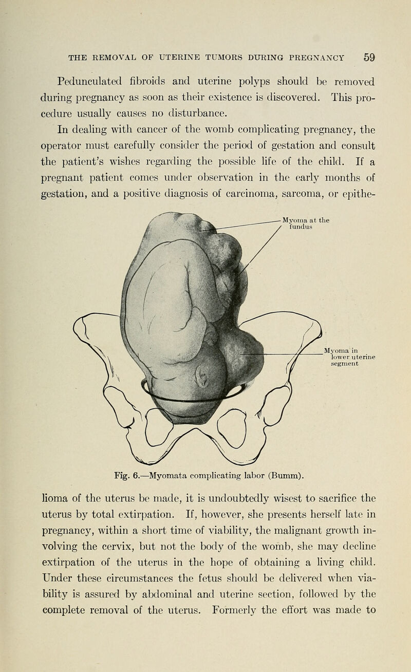 Pedunculated fibroids and uterine polyps should be removed during pregnancy as soon as their existence is discovered. This pro- cedure usually causes no disturbance. In dealing with cancer of the womb complicating pregnancy, the operator must carefully consider the period of gestation and consult the patient's wishes regarding the possible life of the child. If a pregnant patient comes under observation in the early months of gestation, and a positive diagnosis of carcinoma, sarcoma, or epithe- Myoma at the fundus Myoma in lower uterine segment Fig. 6.—Myomata complicating labor (Bumm). lioma of the uterus be made, it is undoubtedly wisest to sacrifice the uterus by total extirpation. If, however, she presents herself late in pregnancy, within a short time of viability, the malignant growth in- volving the cervix, but not the body of the womb, she may decline extirpation of the uterus in the hope of obtaining a living child. Under these circumstances the fetus should be delivered when via- bility is assured by abdominal and uterine section, followed by the complete removal of the uterus. Formerly the effort was made to