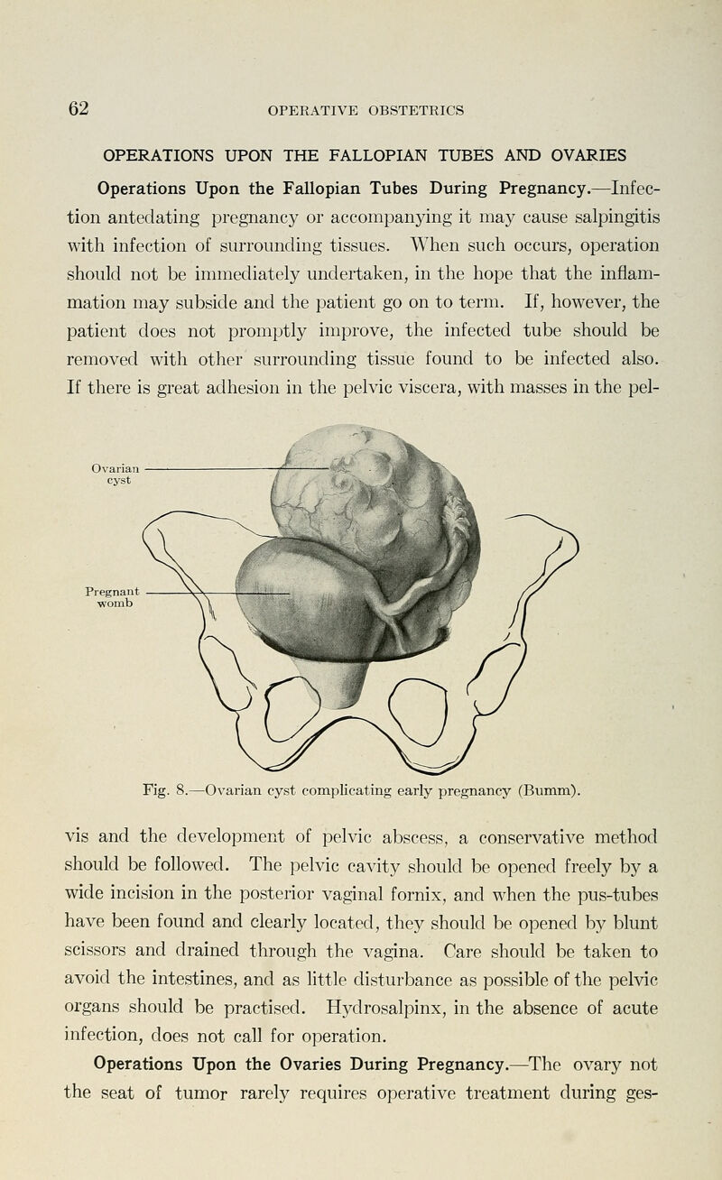 OPERATIONS UPON THE FALLOPIAN TUBES AND OVARIES Operations Upon the Fallopian Tubes During Pregnancy.—Infec- tion antedating pregnancy or accompanying it may cause salpingitis with infection of surrounding tissues. When such occurs, operation should not be immediately undertaken, in the hope that the inflam- mation may subside and the patient go on to term. If, however, the patient does not promptly improve, the infected tube should be removed with other surrounding tissue found to be infected also. If there is great adhesion in the pelvic viscera, with masses in the pel- Fig. 8.—Ovarian cyst complicating early pregnancy (Bumm). vis and the development of pelvic abscess, a conservative method should be followed. The pelvic cavity should be opened freely by a wide incision in the posterior vaginal fornix, and when the pus-tubes have been found and clearly located, they should be opened by blunt scissors and drained through the vagina. Care should be taken to avoid the intestines, and as little disturbance as possible of the pelvic organs should be practised. Hydrosalpinx, in the absence of acute infection, does not call for operation. Operations Upon the Ovaries During Pregnancy.—The ovary not the seat of tumor rarely requires operative treatment during ges-