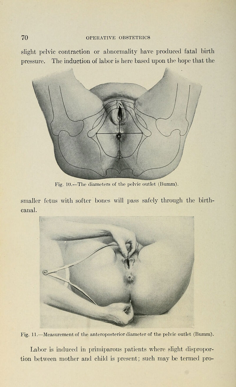slight pelvic contraction or abnormality have produced fatal birth pressure. The induction of labor is here based upon the hope that the Fig. 10.—The diameters of the pelvic outlet (Bumm). smaller fetus with softer bones will pass safely through the birth- canal. Fig. 11.—Measurement of the anteroposterior diameter of the pelvic outlet (Bumm). Labor is induced in primiparous patients where slight dispropor- tion between mother and child is present; such may be termed pro-
