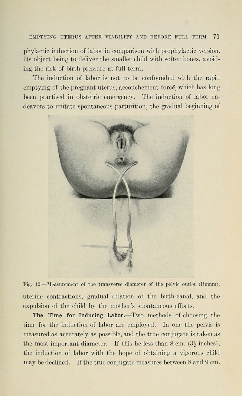 phylactic induction of labor in comparison with prophylactic version. Its object being to deliver the smaller child with softer bones, avoid- ing the risk of birth pressure at full term. The induction of labor is not to be confounded with the rapid emptying of the pregnant uterus, accouchement forc^, which has long been practised in obstetric emergency. The induction of labor en- deavors to imitate spontaneous parturition, the gradual beginning of Fig. 12.—Measurement of the transverse diameter of the pelvic outlet (Bumm). uterine contractions, gradual dilation of the birth-canal, and the expulsion of the child by the mother's spontaneous efforts. The Time for Inducing Labor.—Two methods of choosing the time for the induction of labor are employed. In one the pelvis is measured as accurately as possible, and the true conjugate is taken as the most important diameter. If this be less than 8 cm. (Sh inches), the induction of labor with the hope of obtaining a vigorous child may be declined. If the true conjugate measures between 8 and 9 cm.