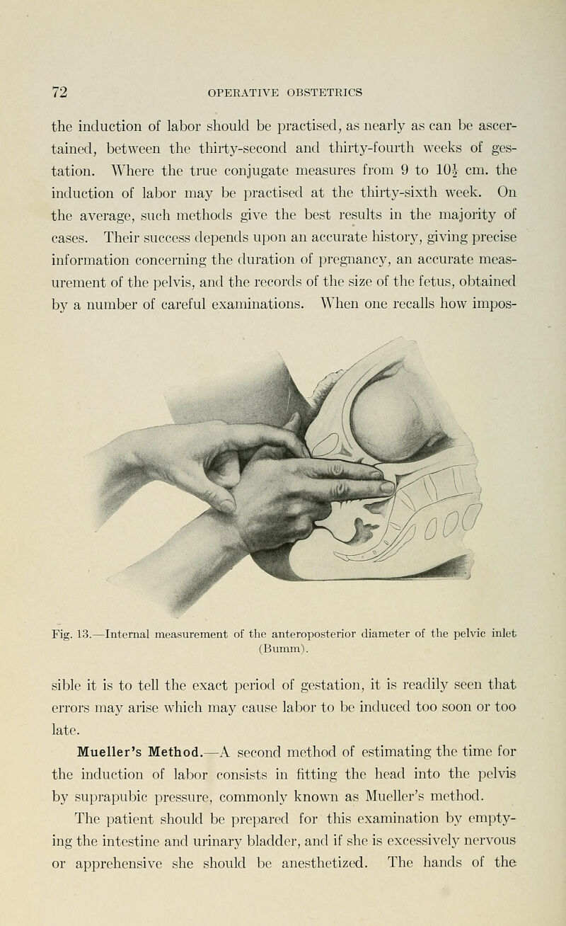 the induction of labor should be practised, as nearly as can be ascer- tained, between the thirty-second and thirty-fourth weeks of ges- tation. Where the true conjugate measures from 9 to 10J cm. the induction of labor may be practised at the thirty-sixth week. On the average, such methods give the best results in the majority of cases. Their success depends upon an accurate history, giving precise information concerning the duration of pregnancy, an accurate meas- urement of the pelvis, and the records of the size of the fetus, obtained by a number of careful examinations. When one recalls how impos- Fig. 13.—Internal measurement of the anteroposterior diameter of the pelvic inlet (Bumm). sible it is to teh the exact period of gestation, it is readily seen that errors may arise which may cause labor to be induced too soon or too late. Mueller's Method.—A second method of estimating the time for the induction of labor consists in fitting the head into the pelvis by suprapubic pressure, commonly known as Mueller's method. The patient should be prepared for this examination by empty- ing the intestine and urinary bladder, and if she is excessively nervous or apprehensive she should be anesthetized. The hands of the